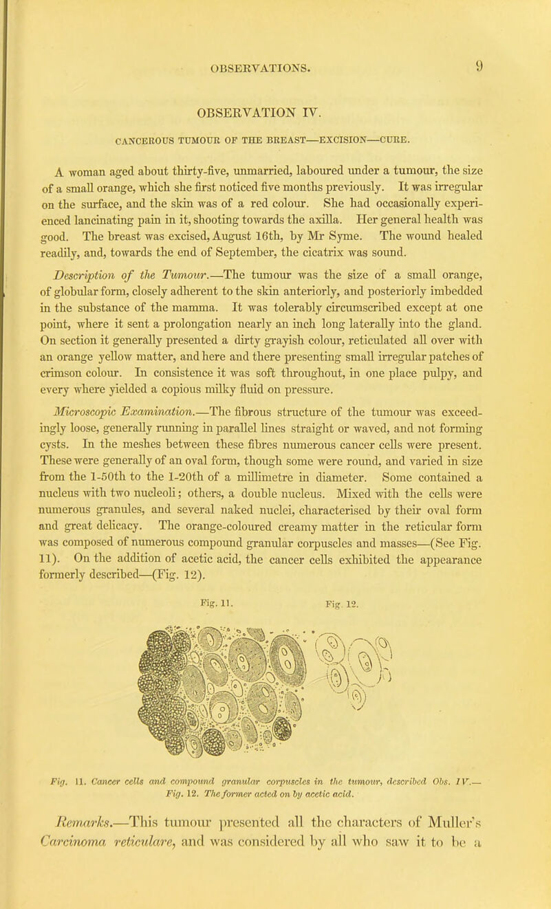 OBSERVATION IV. CANCEROUS TUMOUR OF THE BREAST—EXCISION—CURE. A woman aged about thirty-five, unmarried, laboured under a tumour, the size of a small orange, which she first noticed five months previously. It was irregular on the surface, and the skin was of a red colour. She had occasionally experi- enced lancinating pain in it, shooting towards the axilla. Her general health was good. The breast was excised, August 16th, by Mr Syme. The wound healed readily, and, towards the end of September, the cicatrix was sound. Description of the Tumour.—The tumour was the size of a small orange, of globular form, closely adherent to the skin anteriorly, and posteriorly imbedded in the substance of the mamma. It was tolerably circumscribed except at one point, where it sent a prolongation nearly an inch long laterally into the gland. On section it generally presented a dirty grayish colour, reticulated all over with an orange yellow matter, and here and there presenting small irregular patches of crimson colour. In consistence it was soft throughout, in one place pulpy, and every where yielded a copious milky fluid on pressure. Microscopic Examination.—The fibrous structure of the tumour was exceed- ingly loose, generally running in parallel lines straight or waved, and not forming cysts. In the meshes between these fibres numerous cancer cells were present. These were generally of an oval form, though some were round, and varied in size from the l-50th to the l-20th of a millimetre in diameter. Some contained a nucleus with two nucleoli; others, a double nucleus. Mixed with the cells were numerous granules, and several naked nuclei, characterised by then oval form and great delicacy. The orange-colomed creamy matter in the reticular form was composed of numerous compound granular corpuscles and masses—(See Fig. 11). On the addition of acetic acid, the cancer cells exhibited the appearance formerly described—(Fig. 12). Fig. 11. Fig. 12. Fig. 11. Cancer cells and compound granular corpuscles in the tumour, described Ohs. IV.— Fig. 12. The former acted on by acetic acid. Remarks.—This tumour presented all the characters of Muller’s Carcinoma\ reticulare, and was considered by all who saw it to be a