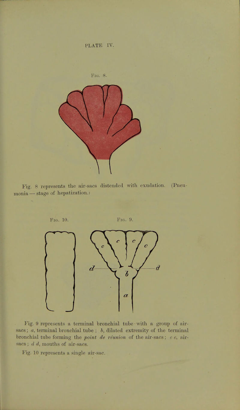 Fid. 8. Fig. 8 represents the air-sacs distended with exudation. (Pneu- monia — stage of hepatization, i Fm. 10. Fig. 9. Fig. 9 represents a terminal bronchial tube with a group of air- sacs ; a, terminal bronchial tube ; h, dilated extremity of the terminal bronchial tube forming the point de reunion of the air-sacs; c c, aii-- sacs ; d d, mouths of air-sacs.