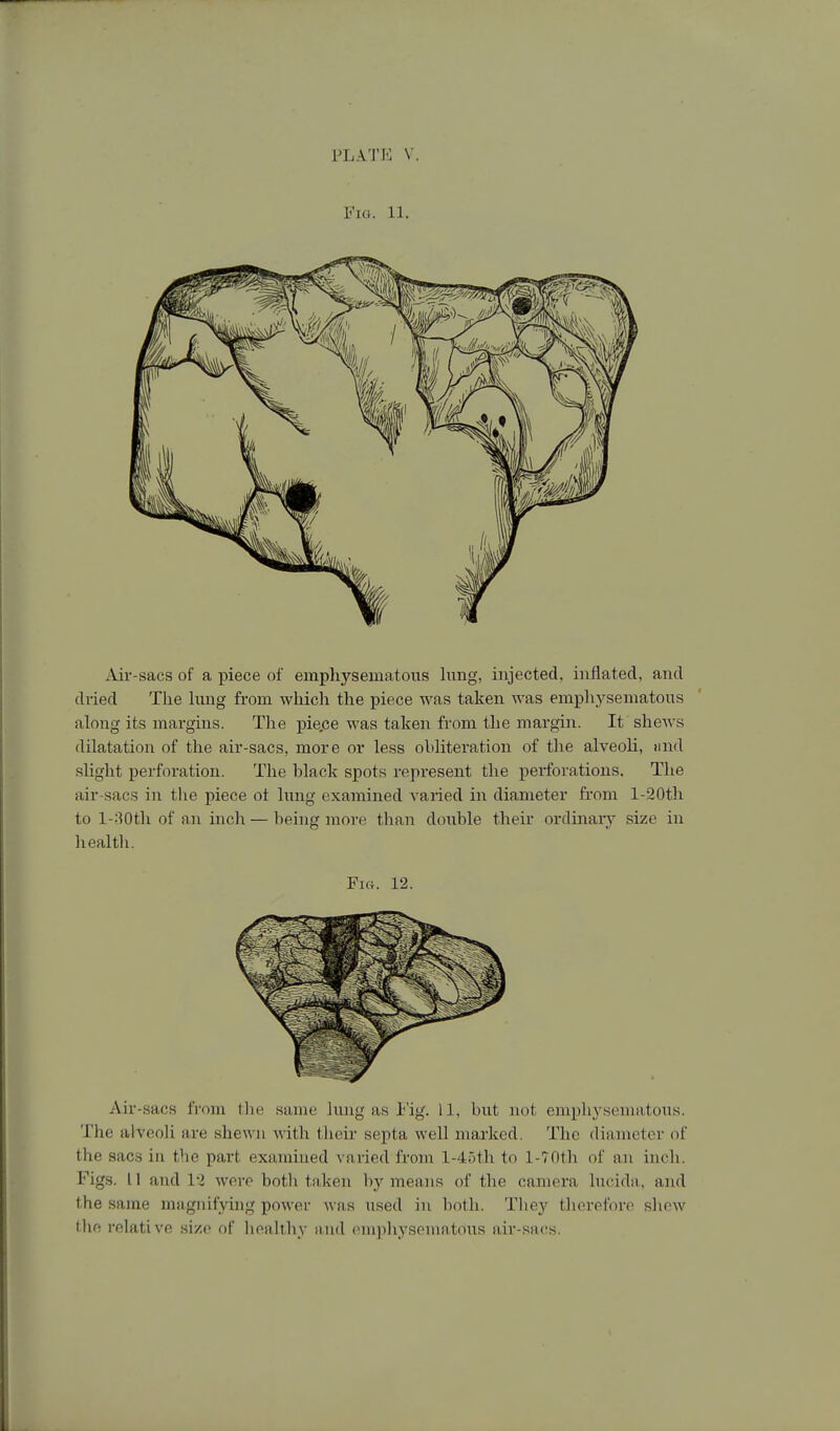 VhkTK V Fio. 11. Air-sacs of a piece of empliysematous lung, injected, inflated, and dried The liuig from which the piece was taken was empliysematous along its margins. The pie.ce was taken from the margin. It shews dilatation of the air-sacs, more or less obliteration of the alveoli, and sHght perforation. The black spots represent the perforations. The air-sacs in tlie piece ot lung examined varied in diameter fi-om l-20th to l-:30tli of an inch — being more than double their ordiuaiy size in liealtli. Fitt. 12. Air-sacs from the same lung as i'ig. 11, but not emphysematous. The alveoli are shewn with tlunr septa well marked. The dianietor of the sacs in the part examined varied from l-45th to 1-TOth of an inch. Figs. 11 and 13 were both taken by means of the camera lucida, and the same magnifying power was used in both. They therefore sliew the relative si/e of henlihy and emphysematous air-sacs.