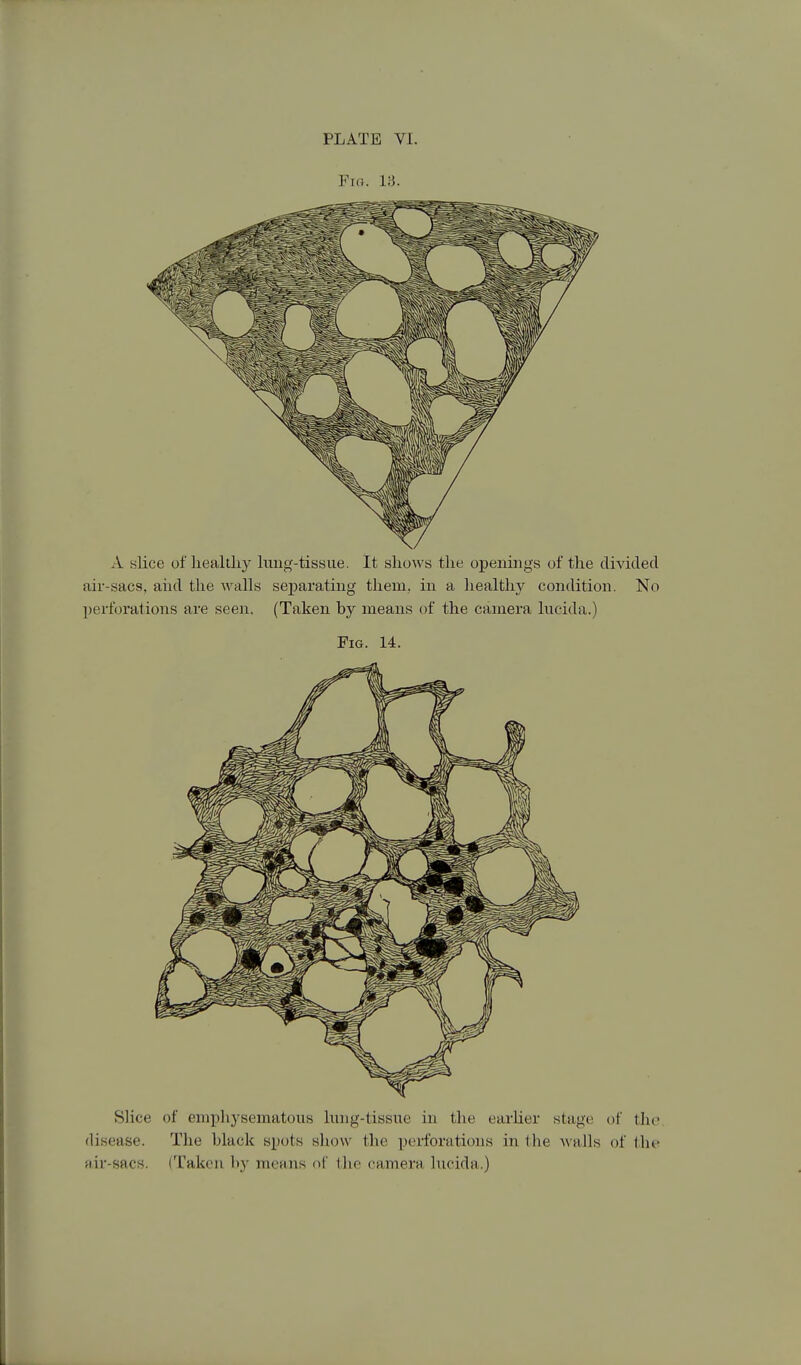 Fia. l;J. A slice of liealtliy lung-tissue. It shows the openings of the divided air-sacs, aiid the walls separating them, in a healthy condition. No perforations are seen. (Taken by means of the camera lucida.) Fig. 14. Slice of emphysematous lung-tissue in the earlier stage of the. disease. The black spots show the perforations in the Avails of the fiir-sacs. (Taken by means of the camera lucida.)