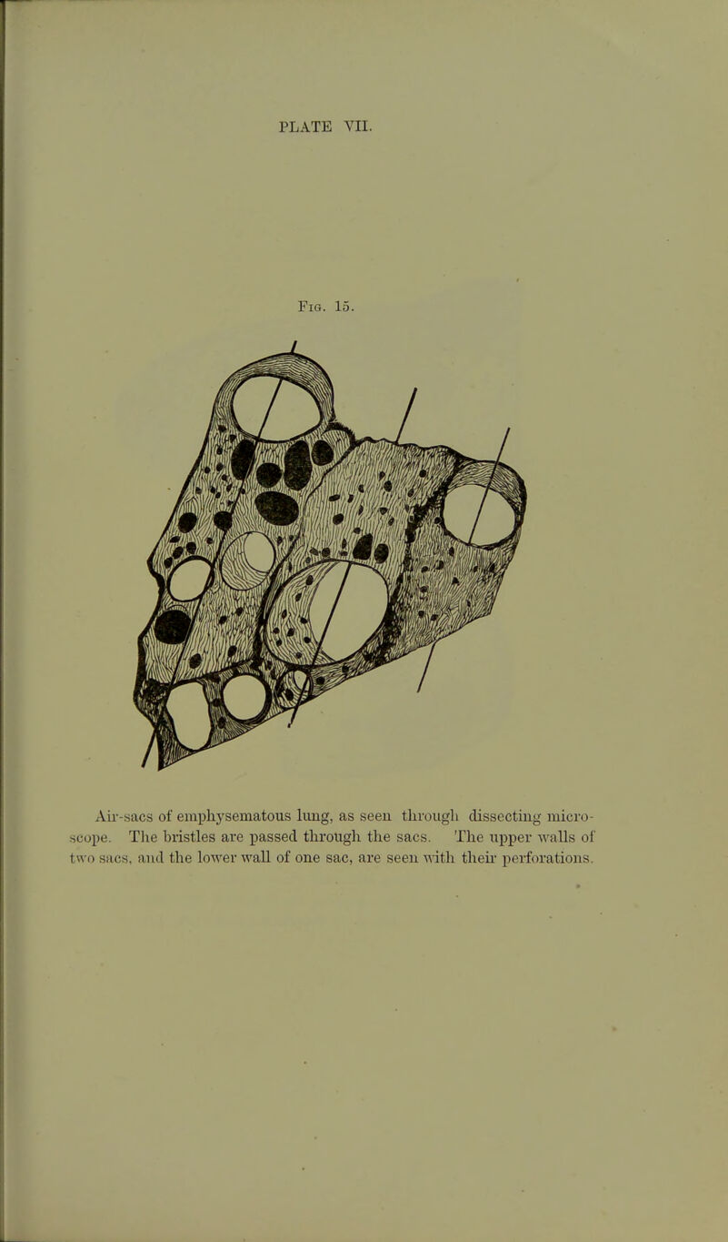 Fig. 15. Aii'-sacs of emphysematous lung, as seeu tlirougli dissecting micro- scope. Tlie bristles are passed through the sacs. The tipper walls of two sacs, and the lower wall of one sac, are seen vath then- perforations.