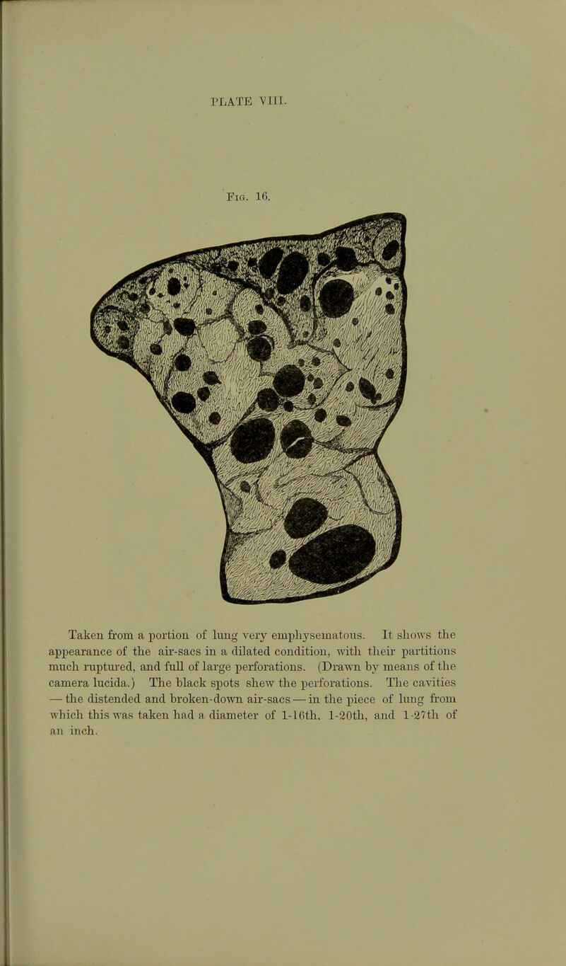 Fig. 16. Taken from a iJortiou of limg very empliysematoiis. It sliows the appearance of the air-sacs in a dilated condition, with their partitions much iiiptm-ed, and full of large perforations. (Dra^^^l by means of the camera lucida.) The black spots shew the perforations. The ca-\dties — the distended and broken-down air-sacs — in the piece of hmg from which this was taken had a diameter of l-16th. l-20th, and l-27th of an inch.