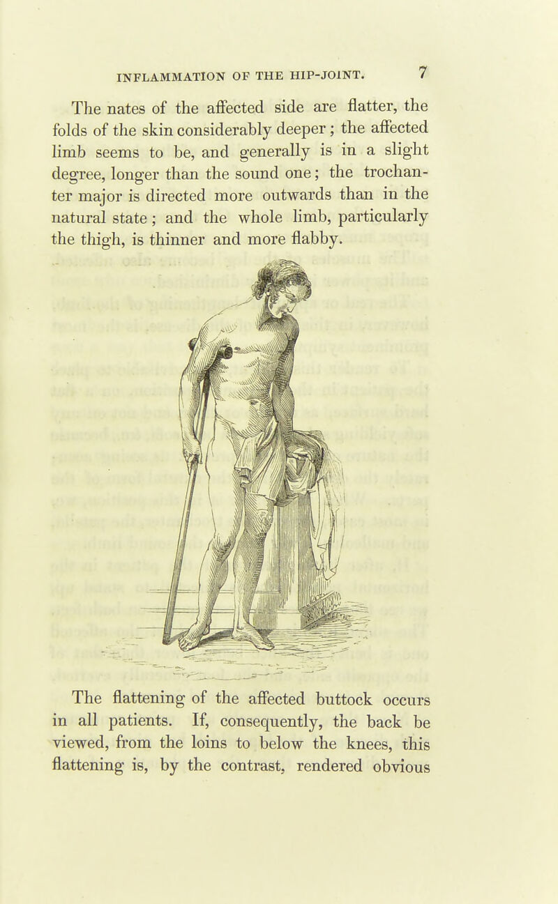 The nates of the affected side are flatter, the folds of the skin considerably deeper; the affected limb seems to be, and generally is in a slight degree, longer than the sound one; the trochan- ter major is directed more outwards than in the natural state; and the whole limb, particularly the thigh, is thinner and more flabby. The flattening of the affected buttock occurs in all patients. If, consequently, the back be viewed, from the loins to below the knees, this flattening is, by the contrast, rendered obvious