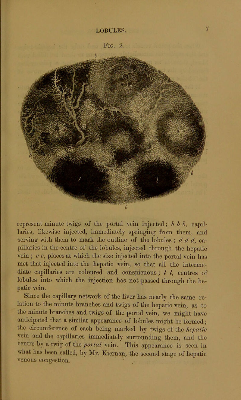 LOBULES. Fig. 2. represent minute twigs of the portal vein injected; b b b, capil- laries, likewise injected, immediately springing from them, and serving with them to mark the outhne of the lohules d d d, ca- pillaries in the centre of the lohules, injected through the hepatic vein ; e e, places at which the size injected into the portal vein has met that injected into the hepatic vein, so that all the interme- diate capillaries are coloured and conspicuous; I I, centres of lohules into which the injection has not passed through the he- patic vein. Since the capillary network of the liver has nearly the same re- lation to the minute branches and twigs of the hepatic vein, as to the minute branches and twigs of the portal vein, we might have anticipated that a similar appearance of lobules might be formed; the circumference of each being marked by twigs of the hepatic vein and the capillaries immediately suiTounding them, and the centre by a twig of the portal vein. This appearance is seen in what has been called, by Mr. Kiernan, the second stage of hepatic venous congestion.