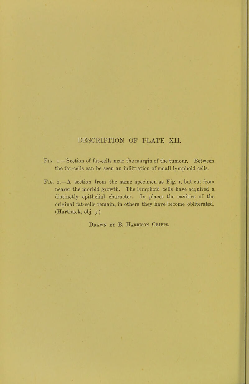 Fi&. 1.—Section of fat-cells near the margin of the tumour. Between the fat-cells can be seen an infiltration of small lymphoid cells. Fig. 2.—A section from the same specimen as Fig. i, but cut from nearer the morbid growth. The lymphoid cells have acquired a distinctly epithelial character. In places the cavities of the original fat-cells remain, in others they have become obliterated. (Hartnack, obj. 9.)