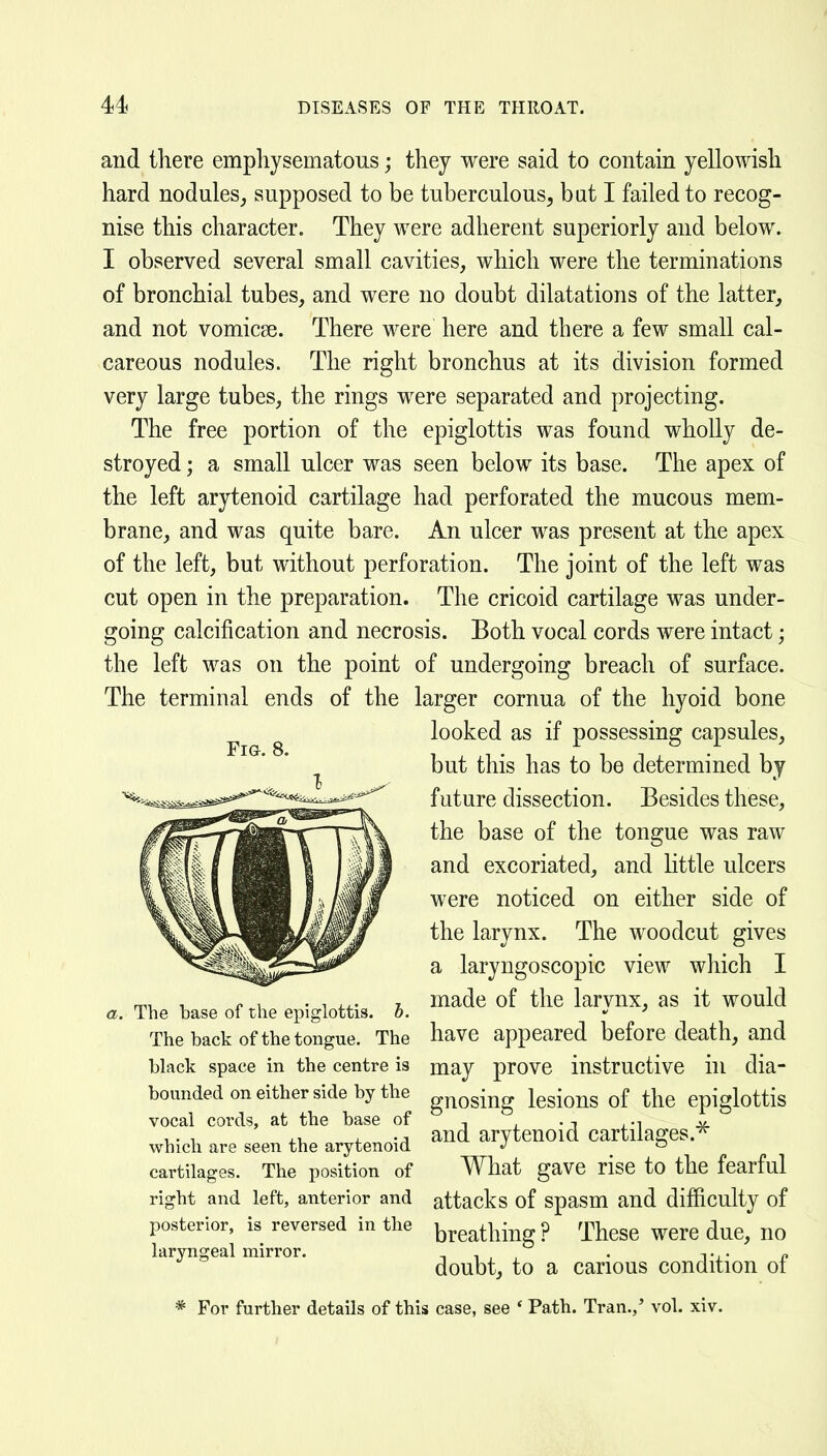 and there emphysematous; they were said to contain yellowish hard nodules^ supposed to be tuberculous^ bat I failed to recog- nise this character. They were adherent superiorly and below. I observed several small cavities, which were the terminations of bronchial tubes, and were no doubt dilatations of the latter, and not vomicae. There were here and there a few small cal- careous nodules. The right bronchus at its division formed very large tubes, the rings were separated and projecting. The free portion of the epiglottis was found wholly de- stroyed ; a small ulcer was seen below its base. The apex of the left arytenoid cartilage had perforated the mucous mem- brane, and was quite bare. An ulcer was present at the apex of the left, but without perforation. The joint of the left was cut open in the preparation. The cricoid cartilage was under- going calcification and necrosis. Both vocal cords were intact; the left was on the point of undergoing breach of surface. The terminal ends of the larger cornua of the hyoid bone looked as if possessing capsules, but this has to be determined by future dissection. Besides these, the base of the tongue was raw and excoriated, and Httle ulcers were noticed on either side of the larynx. The woodcut gives a laryngoscopic view which I made of the larynx, as it would have appeared before death, and may prove instructive hi dia- gnosing lesions of the epiglottis and arytenoid cartilages.^ What gave rise to the fearful attacks of spasm and difiiculty of breathing ? These were due, no doubt, to a carious condition of * For further details of this case, see * Path. Tran.,' vol. xiv. Fig. 8. a. The hase of the epiglottis, h. The back of the tongue. The black space in the centre is bounded on either side by the vocal cords, at the base of which are seen the arytenoid cartilages. The position of right and left, anterior and posterior, is reversed in the laryngeal mirror.