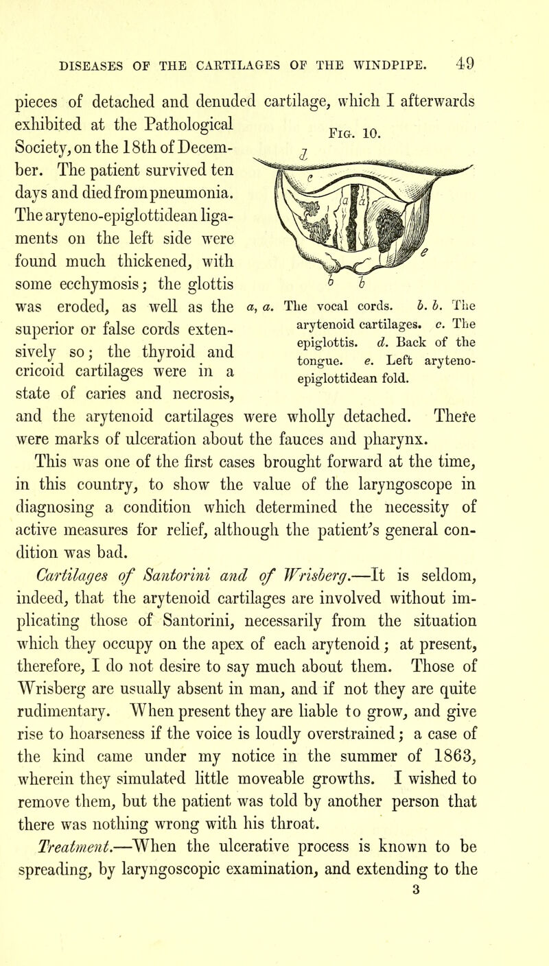 a, a. The vocal cords. h. h. The arytenoid cartilages, c. The epiglottis. d. Back of the tongue. e. Left aryteno- epiglottidean fold. pieces of detached and denuded cartilage, which I afterwards exhibited at the Pathological Society, on the 18th of Decem- ber. The patient survived ten days and died from pneumonia. The aryteno-epiglottidean liga- ments on the left side were found much thickened, with some ecchymosis; the glottis was eroded, as well as the superior or false cords exten- sively so; the thyroid and cricoid cartilages were in a state of caries and necrosis, and the arytenoid cartilages were wholly detached. There were marks of ulceration about the fauces and pharynx. This was one of the first cases brought forward at the time, in this country, to show the value of the laryngoscope in diagnosing a condition which determined the necessity of active measures for relief, although the patient''s general con- dition was bad. Cartilages of Santorini and of JFrisberg.—It is seldom, indeed, that the arytenoid cartilages are involved without im- plicating those of Santorini, necessarily from the situation which they occupy on the apex of each arytenoid; at present, therefore, I do not desire to say much about them. Those of Wrisberg are usually absent in man, and if not they are quite rudimentary. When present they are liable to grow, and give rise to hoarseness if the voice is loudly overstrained; a case of the kind came under my notice in the summer of 1863, wherein they simulated little moveable growths. I wished to remove them, but the patient was told by another person that there was nothing wrong with his throat. Treatment.—^When the ulcerative process is known to be spreading, by laryngoscopic examination, and extending to the 3