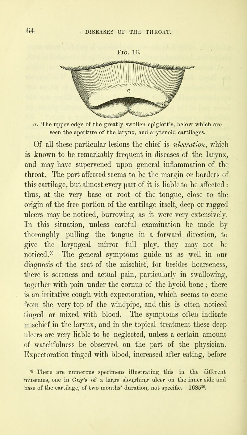 Fig. 16. a. The upper edge of the greatly swollen epiglottis, helow which are . seen the aperture of the larynx, and arytenoid cartilages. Of all these particular lesions the chief is ulceration, which is known to be remarkably frequent in diseases of the larynx, and may have supervened upon general inflammation of the throat. The part afi^ected seems to be the margin or borders of this cartilage,, but almost every part of it is liable to be affected : thus^ at the very base or root of the tongue, close to the origin of the free portion of the cartilage itself, deep or ragged ulcers may be noticed, burrowing as it were very extensively. In this situation, unless careful examination be made by thoroughly pulling the tongue in a forward direction, to give the laryngeal mirror full play, they may not be noticed.^ The general symptoms guide us as well in our diagnosis of the seat of the mischief, for besides hoarseness, there is soreness and actual pain, particularly in swallowing, together with pain under the cornua of the hyoid bone; there is an irritative cough with expectoration, which seems to come from the very top of the windpipe, and this is often noticed tinged or mixed with blood. The symptoms often indicate mischief in the larynx, and in the topical treatment these deep ulcers are very hable to be neglected, unless a certain amount of watchfulness be observed on the part of the physician. Expectoration tinged with blood, increased after eating, before * There are numerous specimens illustrating this in the dilferent museums, one in Guy's of a large sloughing ulcer on the inner side and base of the cartilage, of two months' duration, not specific. 1685''.