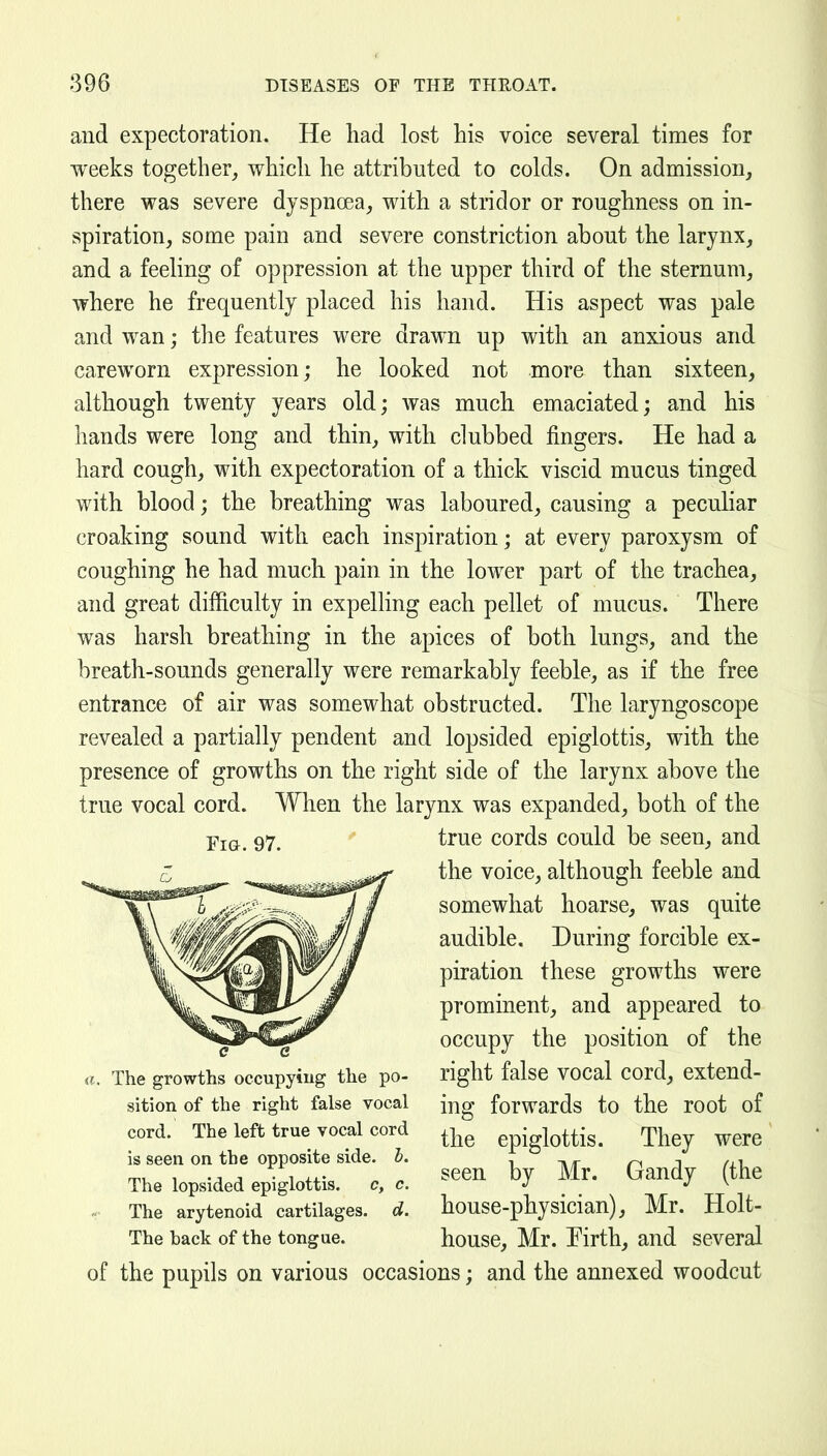 and expectoration. He had lost Ms voice several times for weeks together, which he attributed to colds. On admission, there was severe dyspnoea, with a stridor or roughness on in- spiration, some pain and severe constriction about the larynx, and a feeling of oppression at the upper third of the sternum, where he frequently placed his hand. His aspect was pale and wan; tlie features were drawn up with an anxious and careworn expression; he looked not more than sixteen, although twenty years old; was much emaciated; and his hands were long and thin, with clubbed fingers. He had a hard cough, with expectoration of a thick viscid mucus tinged with blood; the breathing was laboured, causing a peculiar croaking sound with each inspiration; at every paroxysm of coughing he had much pain in the lower part of the trachea, and great difficulty in expelling each pellet of mucus. There was harsh breathing in the apices of both lungs, and the breath-sounds generally were remarkably feeble, as if the free entrance of air was somewhat obstructed. The laryngoscope revealed a partially pendent and lopsided epiglottis, with the presence of growths on the right side of the larynx above the true vocal cord. When the larynx was expanded, both of the true cords could be seen, and the voice, although feeble and somewhat hoarse, was quite audible. During forcible ex- piration these growths were prominent, and appeared to occupy the position of the right false vocal cord, extend- ing forwards to the root of the epiglottis. They were seen by Mr. Gandy (the house-physician), Mr. Holt- house, Mr. rirth, and several of the pupils on various occasions; and the annexed woodcut Fig. 97. «{. The growths occupying the po- sition of the right false vocal cord. The left true vocal cord is seen on the opposite side. I. The lopsided epiglottis. c, c. The arytenoid cartilages, d. The back of the tongue.