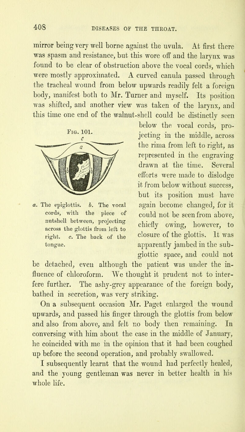 mirror being very well borne against the uvula. At first there was spasm and resistance, but this wore off and the larynx was found to be clear of obstruction above the vocal cords, which were mostly approximated. A curved canula passed through the tracheal wound from below upwards readily felt a foreign body, manifest both to Mr. Turner and myself. Its position was shifted, and another view was taken of the larynx, and this time one end of the walnut-shell could be distinctly seen below the vocal cords, pro- jecting in the middle, across the rima from left to right, as represented in the engraving drawn at the time. Several efforts were made to dislodge it from below without success, but its position must have again become changed, for it could not be seen from above, chiefly owing, however, to closure of the glottis. It was apparently jambed in the sub- glottic space, and could not be detached, even although the patient was under the in- fluence of chloroform. We thought it prudent not to inter- fere further. The ashy-grey appearance of the foreign body, bathed in secretion, was very striking. On a subsequent occasion Mr. Paget enlarged the wound upwards, and passed his finger through the glottis from below and also from above, and felt no body then remaining. In conversing with him about the case in the middle of January, he coincided with me in the opinion that it had been coughed up before the second operation, and probably swallowed. I subsequently learnt that the wound had perfectly healed, and the young gentleman was never in better health in his whole life. The epiglottis, h. cords, with the nutshell between, across the glottis from left to right, c. The back of the tongue. The vocal piece of projecting