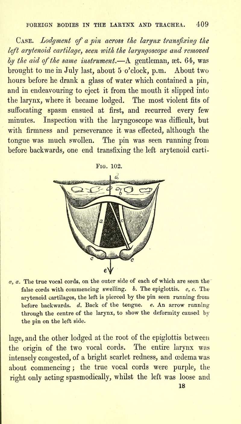 Case. Lodgment of a pin across the larynx transfixing the left arytenoid cartilage, seen with the laryngoscope and removed by the aid of the same instrument.—A gentleman^ set. 64, was brought to me in July last, about 5 o^clock, p.m. About two hours before he drank a glass of water which contained a pin, and in endeavouring to eject it from the mouth it slipped into the larynx, where it became lodged. The most violent fits of suffocating spasm ensued at first, and recurred every few minutes. Inspection with the laryngoscope was difficult, but with firmness and perseverance it was effected, although the tongue was much swollen. The pin was seen running from before backwards, one end transfixing the left arytenoid carti- Fi&. 102. a, a. The true vocal cords, on the outer side of each of which are seen the false cords with commencing swelling, h. The epiglottis, c, c. The arytenoid cartilages, the left is pierced by the pin seen running from before backwards, d. Back of the tongue, e. An arrow running through the centre of the larynx, to show the deformity caused by the pin on the left side. lage, and the other lodged at the root of the epiglottis between the origin of the two vocal cords. The entire larynx was intensely congested, of a bright scarlet redness, and oedema was about commencing; the true vocal cords were purple, the right only acting spasmodically, whilst the left was loose and 18