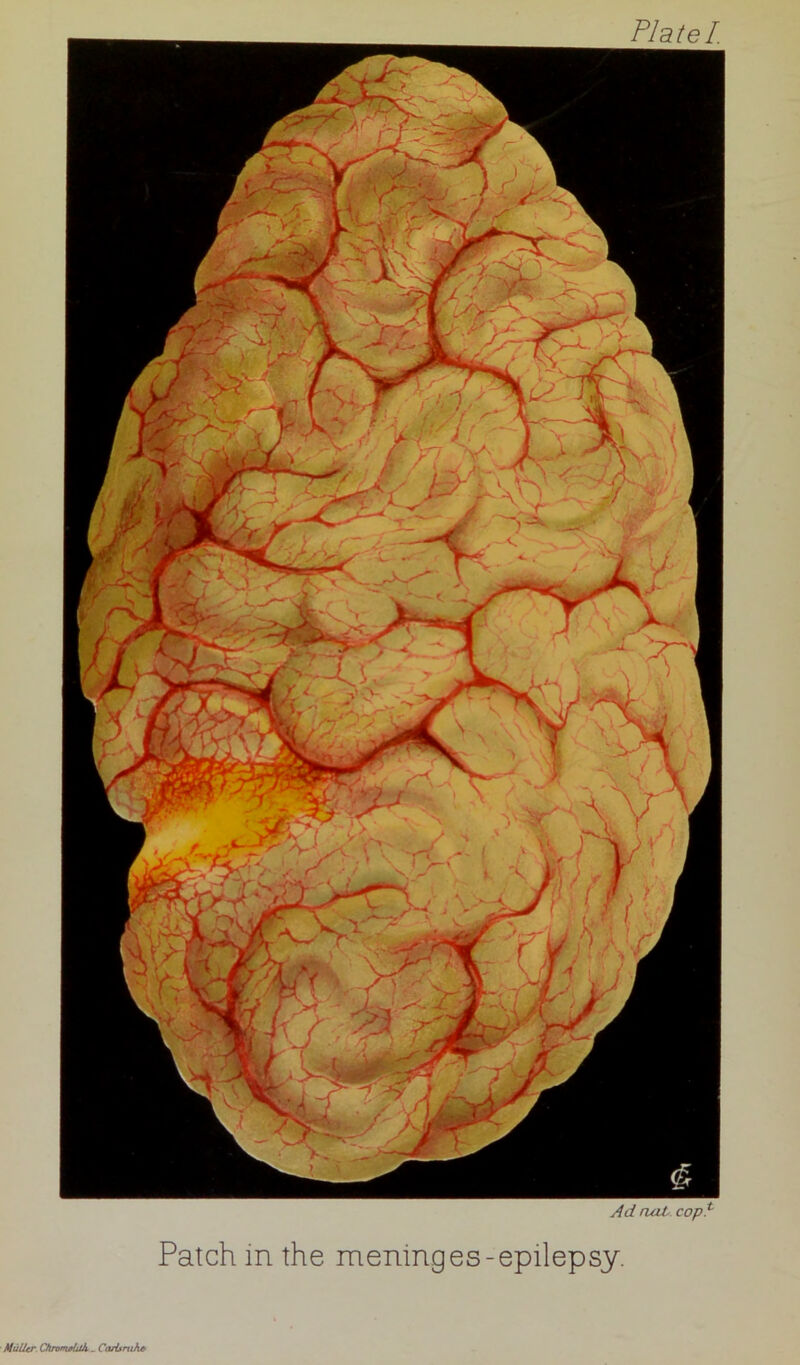 P/o/a T Ad oat copt Patch in the meninges-epilepsy. Muller Qiromrhth _ Carls rtih#