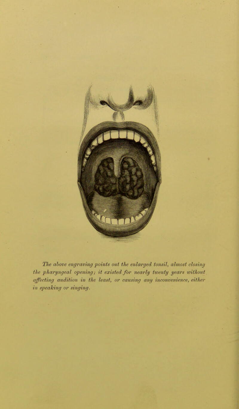 TJie above engraving points out the enlarged tonsil, almost closing the phari/ngeal opening; it existed for nearly twenty years without affecting audition in the least, or causing any inconvenience, either in speaking or singing.