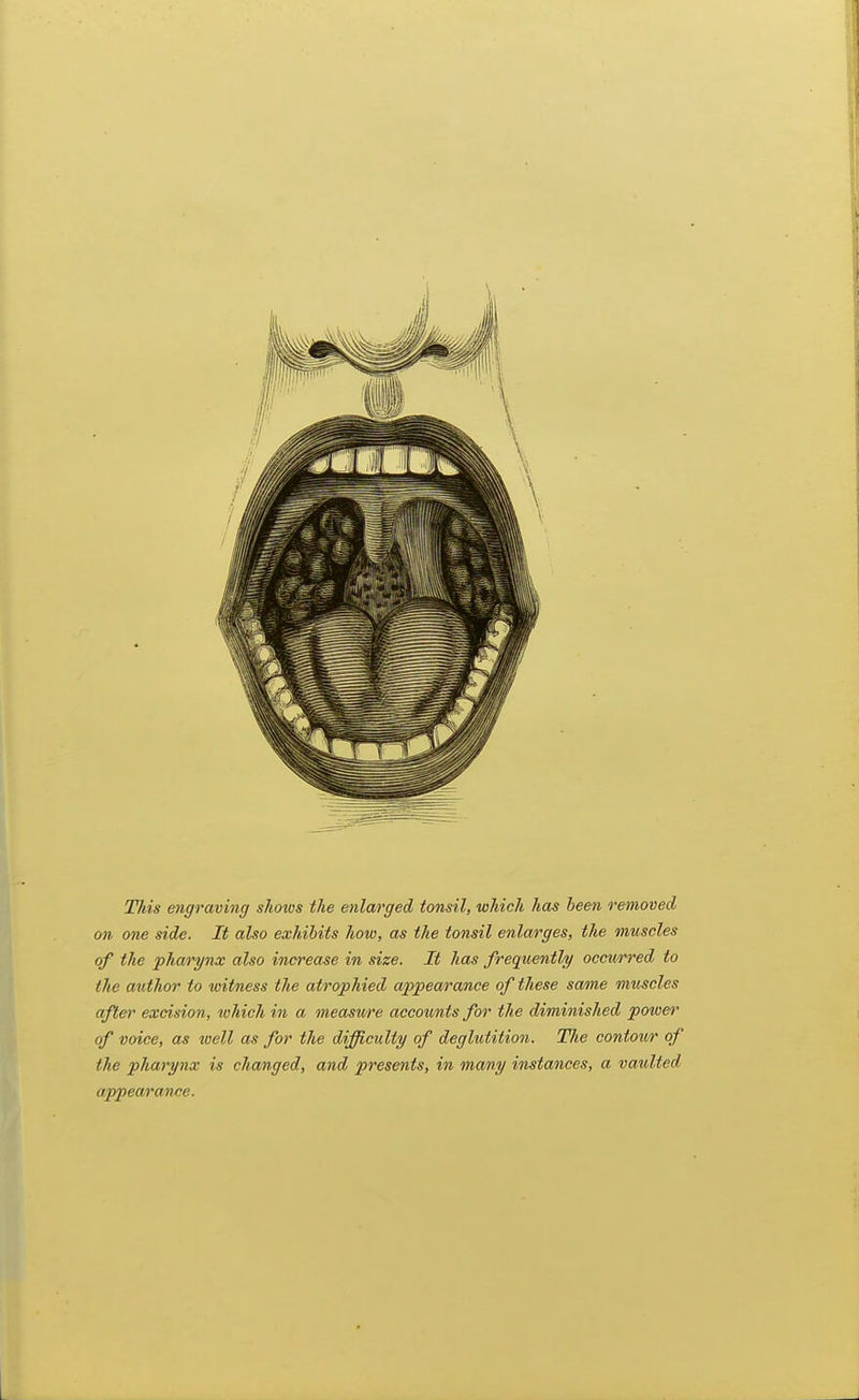 This engraving shows the enlarged tonsil, which has been removed on one side. It also exhibits how, as the tonsil enlarges, the muscles of the pharynx also increase in size. It has frequently occwrred to the author to witness the atrophied appearance of these same muscles after excision, which in a measure accoimis for the diminished power of voice, as well as for the difficuliy of deglutition. The contour of the pharynx is changed, and presents, in many instances, a vaulted appearance.