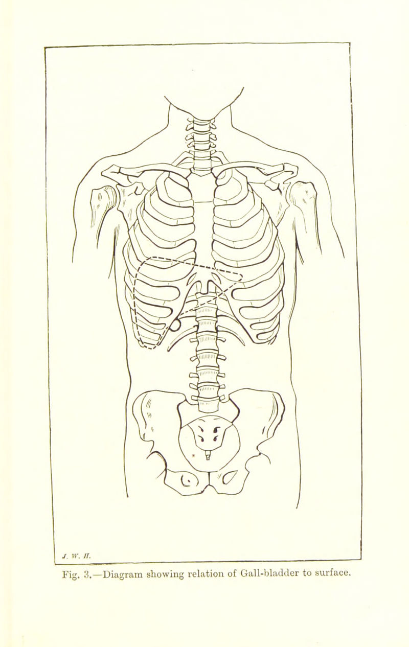 / W. IT. Fig. 3.—Diagram showing reUtiou of Gall-bladder to surface.