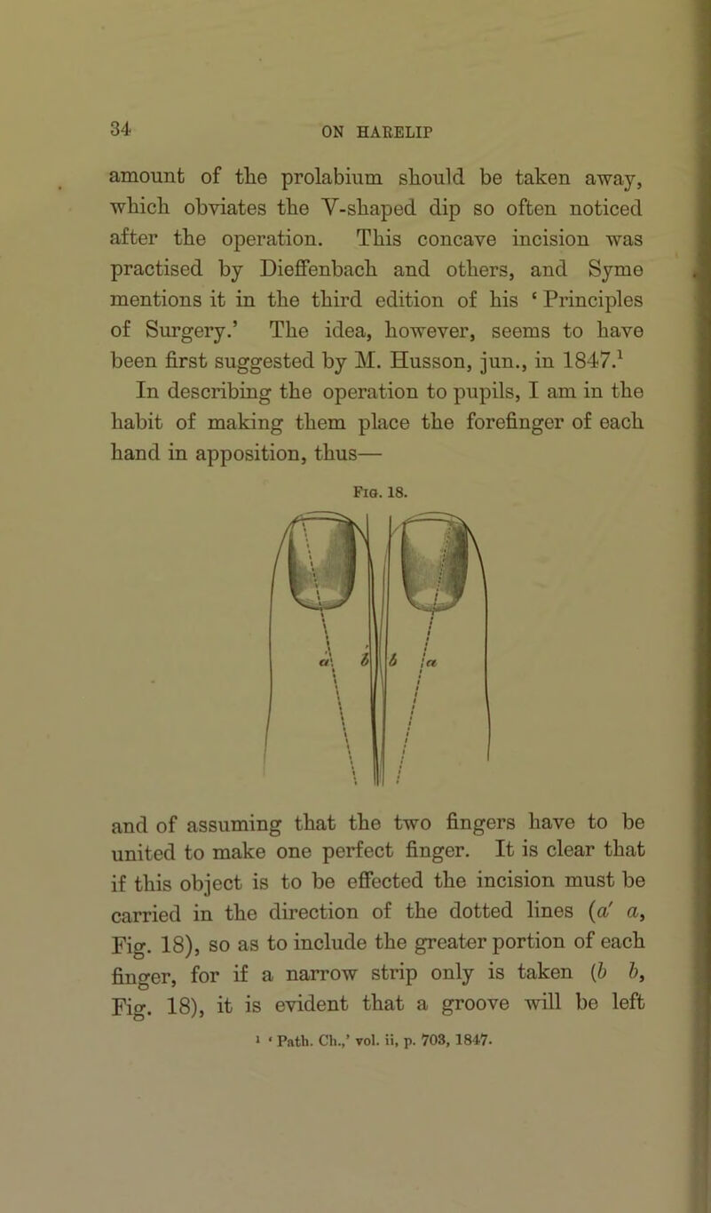 amount of the prolabium should be taken away, which obviates the V-shaped dip so often noticed after the operation. This concave incision was practised by Dieffenbach and others, and Syme mentions it in the third edition of his ‘ Principles of Surgery.’ The idea, however, seems to have been first suggested by M. Husson, jun., in 1847.^ In describing the operation to pupils, I am in the habit of making them place the forefinger of each hand in apposition, thus— Fig. 18. and of assuming that the two fingers have to be united to make one perfect finger. It is clear that if this object is to be effected the incision must be carried in the direction of the dotted lines {a' u. Fig. 18), so as to include the greater portion of each finger, for if a narrow strip only is taken {h b. Fig. 18), it is evident that a groove will be left > ' Piith. Ch.,’ vol. ii, p. 703, 184.7.