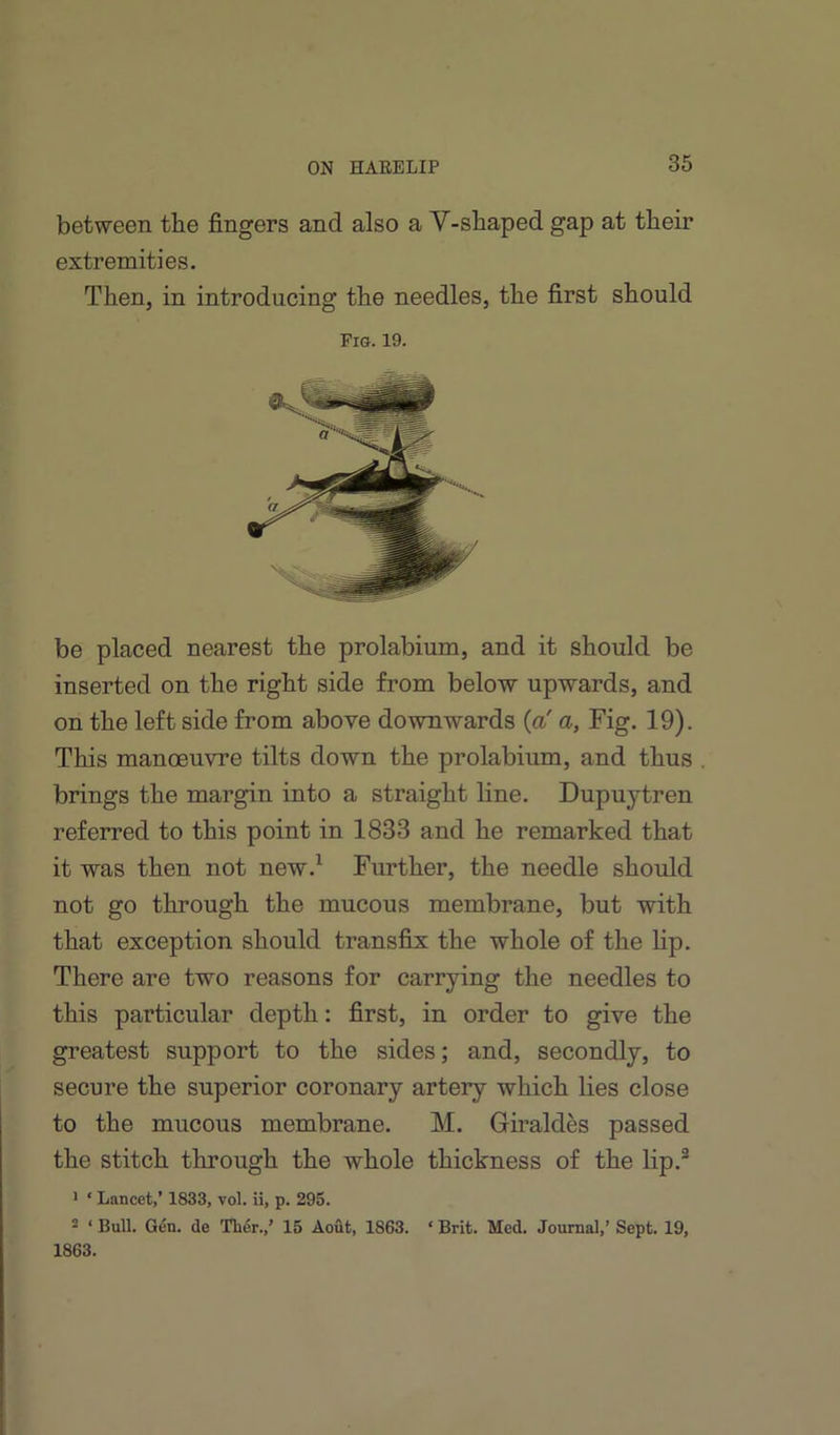 between the fingers and also a Y-shaped gap at their extremities. Then, in introducing the needles, the first should Fro. 19. be placed nearest the prolabium, and it should be inserted on the right side from below upwards, and on the left side from above downwards {a' a, Fig. 19). This manoeuvre tilts down the prolabium, and thus brings the margin into a straight line. Dupuytren referred to this point in 1833 and he remarked that it was then not new.^ Further, the needle should not go through the mucous membrane, but with that exception should transfix the whole of the lip. There are two reasons for carrying the needles to this particular depth: first, in order to give the greatest support to the sides; and, secondly, to secure the superior coronary artery which lies close to the mucous membrane. M. Giraldes passed the stitch through the whole thickness of the lip.® * ‘ Lancet,’ 1833, vol. ii, p. 295. * ‘ Bull. Gen. de Th6r.,’ 15 Aout, 1863. ‘ Brit. Med. Journal,’ Sept. 19, 1863.