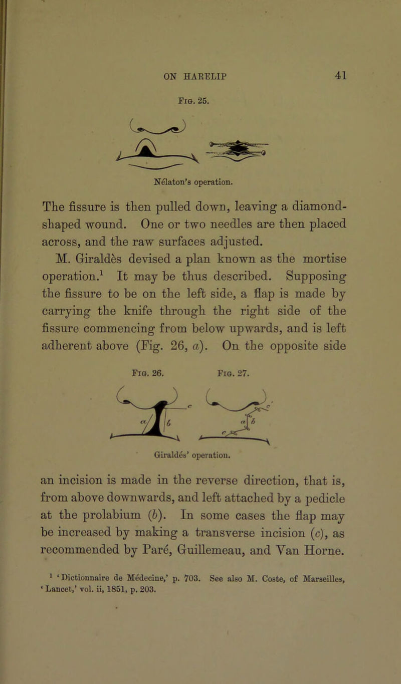 Pig. 25. Nflaton’s operation. The fissure is then pulled down, leaving a diamond- shaped wound. One or two needles are then placed across, and the raw surfaces adjusted. M. Girald^s devised a plan known as the mortise operation.^ It may be thus described. Supposing the fissure to be on the left side, a flap is made by carrying the knife through the right side of the fissure commencing from below upwards, and is left adherent above (Fig. 26, a). On the opposite side Fig. 26. Fig. 27. Giraldes’ operation. an incision is made in the reverse direction, that is, from above downwards, and left attached by a pedicle at the prolabium (fe). In some cases the flap may be increased by making a transverse incision (c), as recommended by Pare, GuiUemeau, and Van Horne. 1 ‘ Dictionnaire de Medecine,’ p. 703. See also M. Coste, of Marseilles, ‘ Lancet,’ vol. ii, 1851, p. 203.