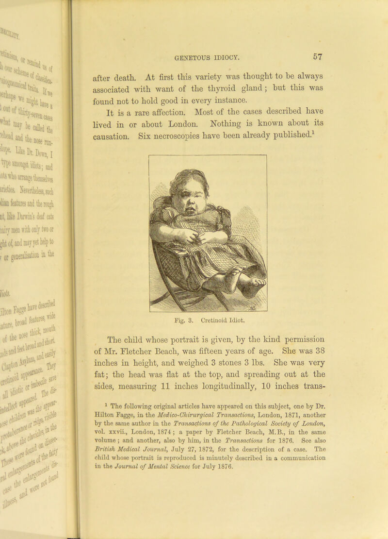 after death. At first this variety was thought to he always associated with want of the thyroid gland ; but this was found not to hold good in every instance. It is a rare affection. Most of the cases described have lived in or about London. Nothing is known about its causation. Six necroscopies have been already published.1 Fig. 3. Cretinoid Idiot. The child whose portrait is given, by the kind permission of Mr. Fletcher Beach, was fifteen years of age. She was 38 inches in height, and weighed 3 stones 3 lbs. She was very fat; the head was flat at the top, and spreading out at the sides, measuring 11 inches longitudinally, 10 inches trans- 1 The following original articles have appeared on this subject, one by Dr. Hilton Fagge, in the Mcdico-Chirurgical Transactions, London, 1871, another by the same author in the Transactions of the Pathological Society of London, vol. xxvii., London, 1874 ; a paper by Fletcher Beach, M.B., in the same volume; and another, also by him, in the Transactions for 1876. See also British Medical Journal, July 27, 1872, for the description of a case. The child whose portrait is reproduced is minutely described in a communication in the Journal of Menial Science for July 1876.