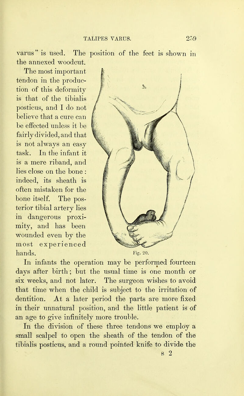 TALIPES VARUS. 2o9 varus is used. The position of the feet is shown in the annexed woodcut. The most important tendon in the jDroduc- tion of this deformity is that of the tibialis posticus, and I do not beheve that a cure can be effected unless it be fairly divided, and that is not always an easy task. In the infant it is a mere riband, and lies close on the bone : indeed, its sheath is often mistaken for the bone itself. The pos- terior tibial artery lies in dangerous proxi- mity, and has been wounded even by the most experienced hands. Fig. 20. In infants the operation may be performed fourteen days after birth; but the usual time is one month or six weeks, and not later. The surgeon wishes to avoid that time when the child is subject to the irritation of dentition. At a later period the parts are more fixed in their unnatural position, and the little patient is of an age to give infinitely more trouble. In the division of these three tendons we employ a small scalpel to open the sheath of the tendon of the tibialis posticus, and a round pointed knife to divide the s 2