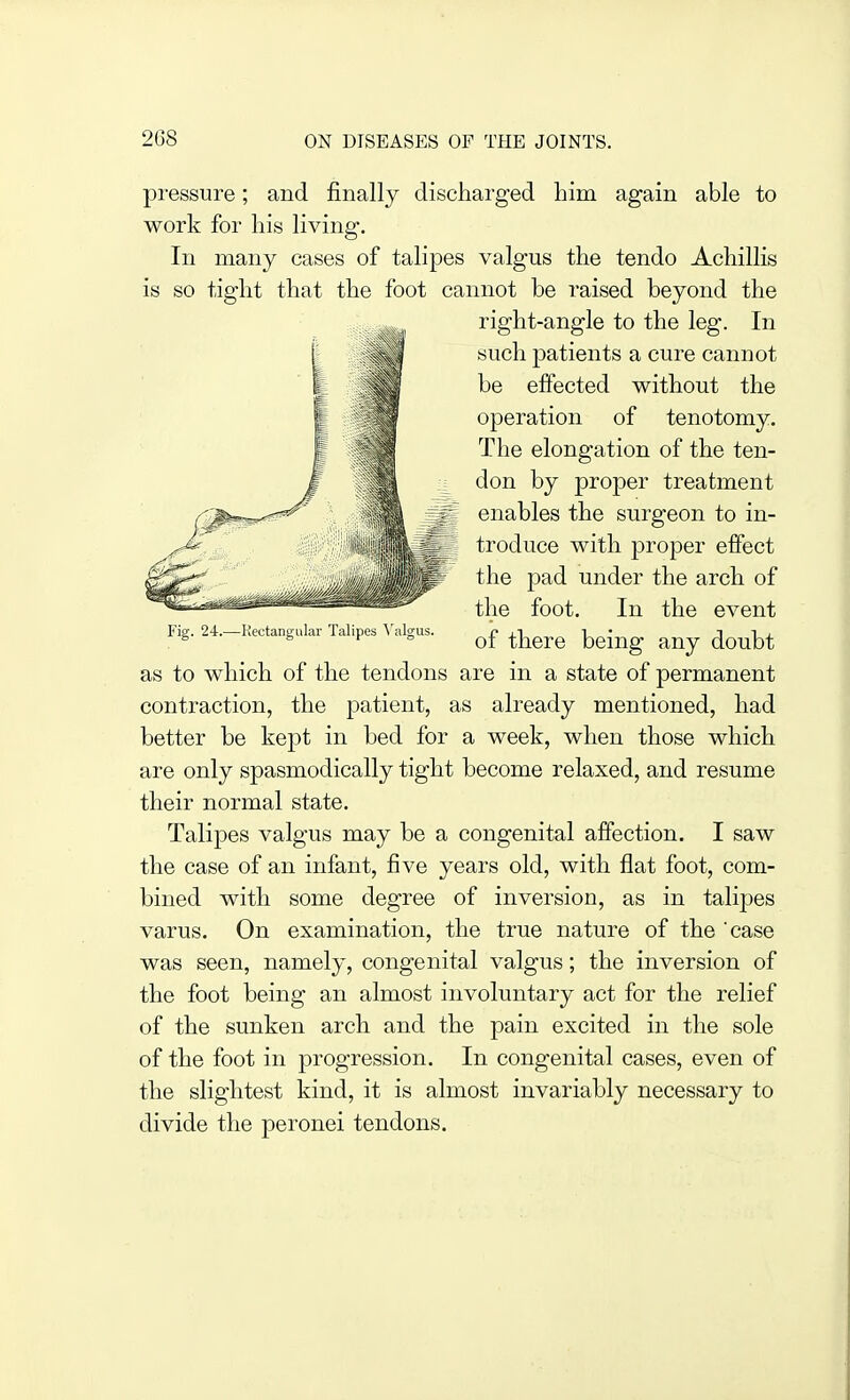 Fig. 24.—Kectangular Talipes A'algus. pressure; and finally discharged him again able to work for his living. In many cases of talipes valgus the tendo Achillis is so tight that the foot cannot be raised beyond the right-angle to the leg. In such patients a cure cannot be effected without the operation of tenotomy. The elongation of the ten- don by proper treatment enables the surgeon to in- troduce with proper effect the pad under the arch of the foot. In the event of there being any doubt as to which of the tendons are in a state of permanent contraction, the patient, as already mentioned, had better be kept in bed for a week, when those which are only spasmodically tight become relaxed, and resume their normal state. Talipes valgus may be a congenital affection. I saw the case of an infant, five years old, with flat foot, com- bined with some degree of inversion, as in talipes varus. On examination, the true nature of the 'case was seen, namely, congenital valgus; the inversion of the foot being an almost involuntary act for the relief of the sunken arch and the pain excited in the sole of the foot in progression. In congenital cases, even of the slightest kind, it is almost invariably necessary to divide the peronei tendons.