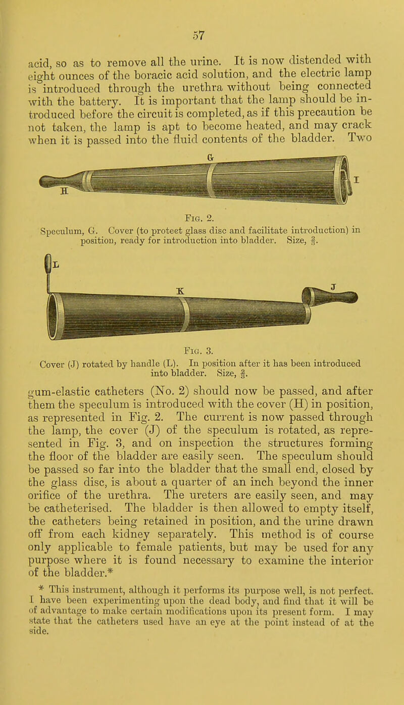 acid, so as to remove all the urine. It is now distended with L'ig-ht ounces of the boracic acid solution, and the electric lamp is introduced through the urethra without being connected with the battery. It is important that the lamp should be in- troduced before the circuit is completed, as if this precaution be not taken, the lamp is apt to become heated, and may crack when it is passed into the fluid contents of the bladder. Two I Fig. 2. Speculum, G. Cover (to protect glass disc and facilitate introduction) in position, ready for introduction into bladder. Size, Fig. 3. Cover (J) rotated by handle (L). In position after it has been introduced into bladder. Size, §. gum-elastic catheters (No. 2) should now be passed, and after Ihem the speculum is introduced with the cover (H) in position, as represented in Fig. 2. The current is now passed through the lamp, the cover (J) of the speculum is rotated, as repre- sented in Fig. 3, and on inspection the structures forming the floor of the bladder are easily seen. The speculum should be passed so far into the bladder that the small end, closed by the glass disc, is about a quarter of an inch beyond the inner orifice of the urethra. The ureters are easily seen, and may be catheterised. The bladder is then allowed to empty itself, the catheters being retained in position, and the urine drawn ofi from each kidney separately. This method is of course only applicable to female patients, but may be used for any purpose where it is found necessary to examine the interior of the bladder.* * This instrument, although it performs its purpose well, is not perfect. I have been experimenting upon the dead body, and find that it will be of advantage to make certain modifications upon its present form. I may state that the catheters used have an eye at the point instead of at the side.