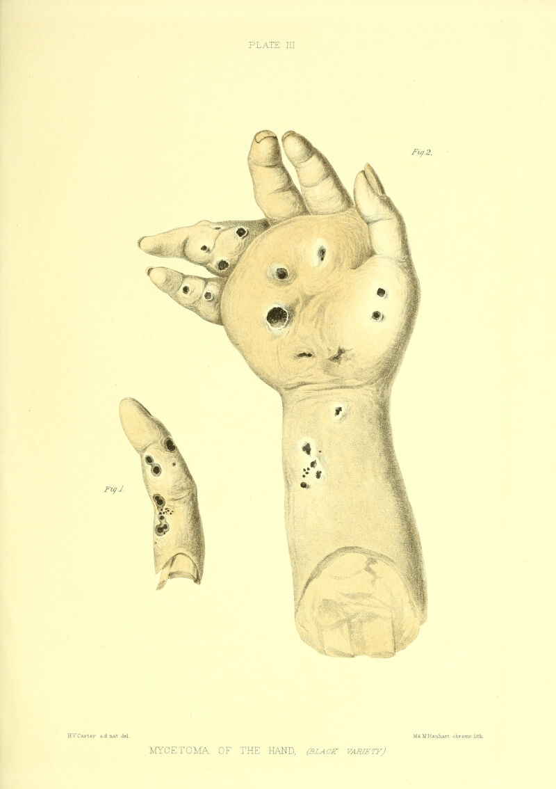 HYCarter ad nat del. MYCETOMA OF THE HAND, (black vabtetyJ MiLMHanliart chromo, litk.