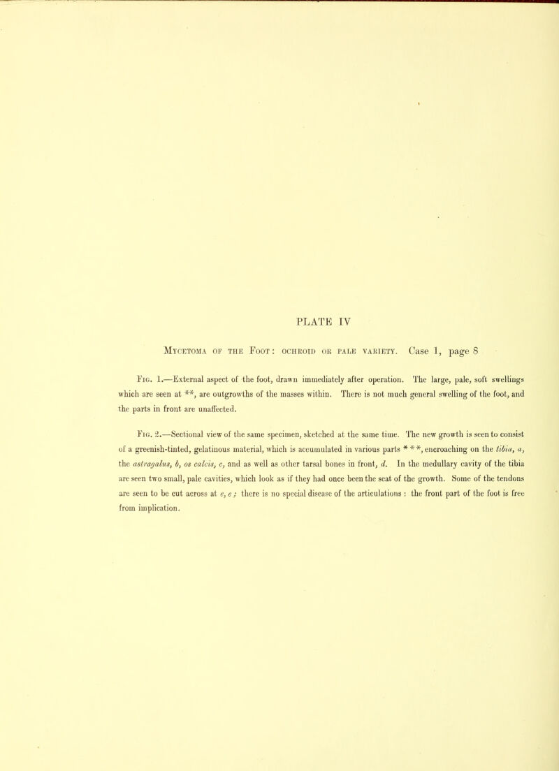 Mycetoma of the Foot : ochrotd ok pale variety. Case 1, page 8 Pig. 1.—External aspect of the foot, drawn immediately after operation. The large, pale, soft swellings which are seen at are outgrowths of the masses within. There is not much general swelling of the foot, and the parts in front are unaffected. EiG. 2.—Sectional view of the same specimen, sketched at the same time. ITie new growth is seen to consist of a greenish-tinted, gelatinous material, which is accumulated in various parts * * encroaching on the tibia, a, the astragalus, b, os calcis, c, and as well as other tarsal bones in front, d. In the medullary cavity of the tibia are seen two small, pale cavities, which look as if they had once been the seat of the growth. Some of the tendons are seen to be cut across at e, e ; there is no special disease of the articulations : the front part of the foot is free from implication.