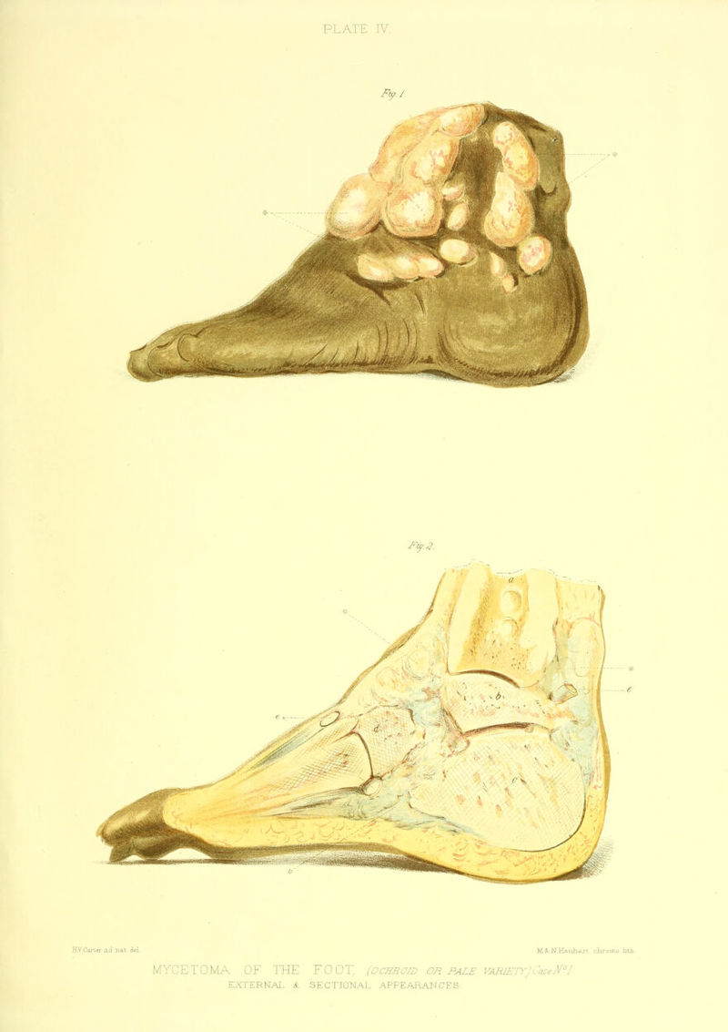 Fry. I. MYCETOMA OF THE' FOOT, {Ochroid EXTERNAL & SECTIONAL .-'\F'PEARANCES,