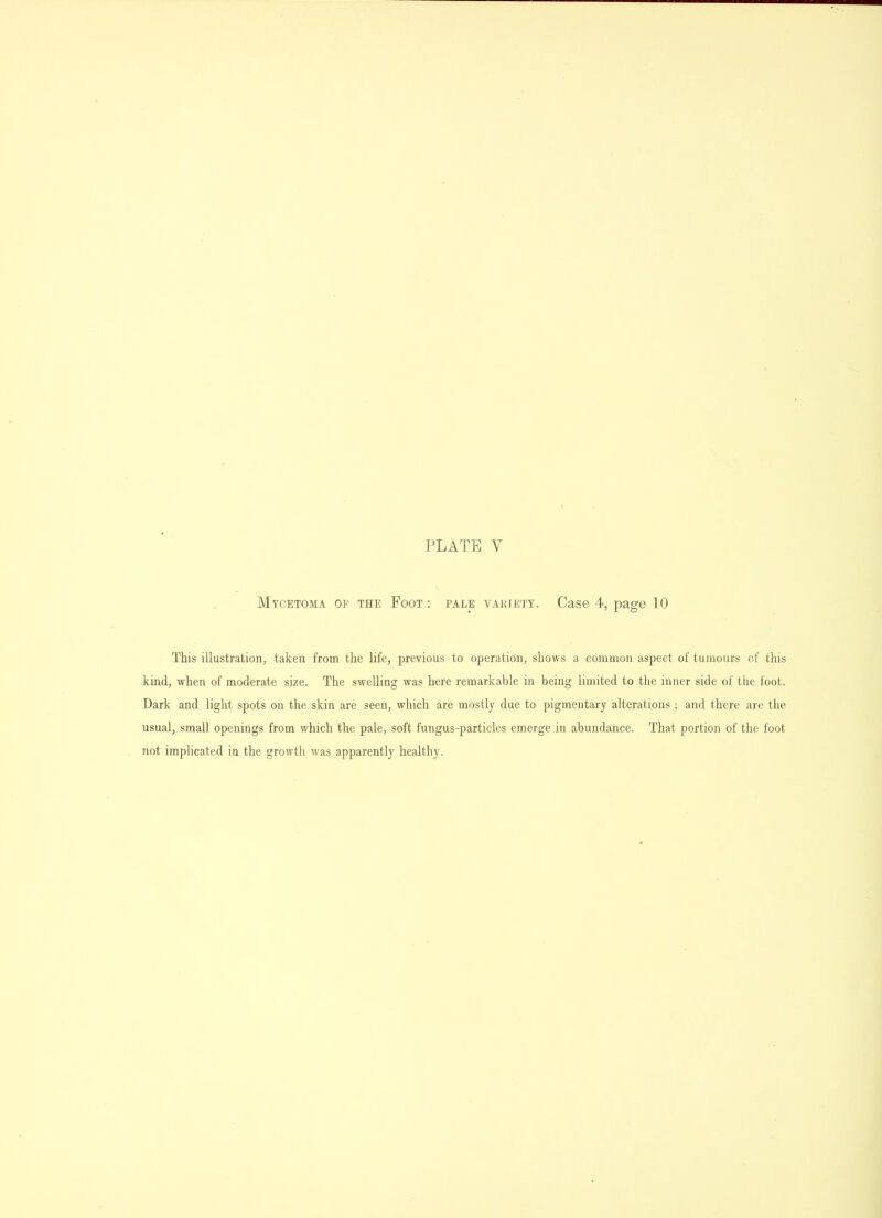 Mycetoma of the Foot : pale vakiett. Case 4, page 10 This illustration, taken from the life, previous to operation, shows a common aspect of tumours of this kind, when of moderate size. The swelling was here remarkable in being limited to tlie inner side of the foot. Dark and light spots on the skin are seen, which are mostly due to pigmentary alterations ; and there are the usual, small openings from which the pale, soft fungus-particles emerge in abundance. That portion of the foot not implicated in the growth was apparently healthy.