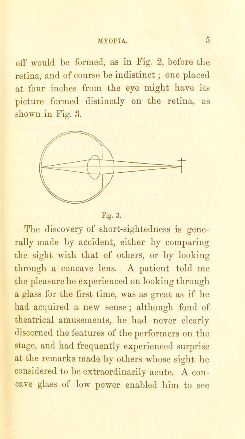 off would be formed, as in Fig. 2, before the retina, and of course be indistinct; one placed at four inches from the eye might have its picture formed distinctly on the retina, as shown in Fig. 3. Fig. 3. The discovery of short-sightedness is gene- rally made by accident, either by comparing the sight with that of others, or by looking through a concave lens. A patient told me the pleasure he experienced on looking through a glass for the first time, was as great as if he had acquired a new sense; although fond of theatrical amusements, he had never clearly discerned the features of the performers on the stage, and had frequently experienced surprise at the remarks made by others whose sight he considered to be extraordinarily acute. A con- cave glass of low power enabled him to see