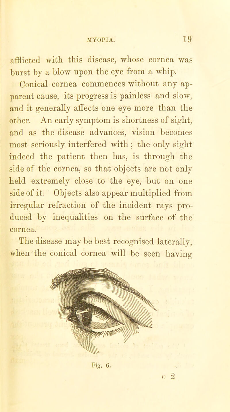 afflicted with this disease, whose cornea was burst by a blow upon the eye from a whip. Conical cornea commences without any ap- parent cause, its progress is painless and slow, and it generally affects one eye more than the other. An early symptom is shortness of sight, and as the disease advances, vision becomes most seriously interfered with ; the only sight indeed the patient then has, is through the side of the cornea, so that objects are not only held extremely close to the eye, but on one side of it. Objects also appear multiplied from irregular refraction of the incident rays pro- duced by inequalities on the surface of the cornea. The disease may be best recognised laterally, when the conical cornea will be seen having Fig. 6. C 2