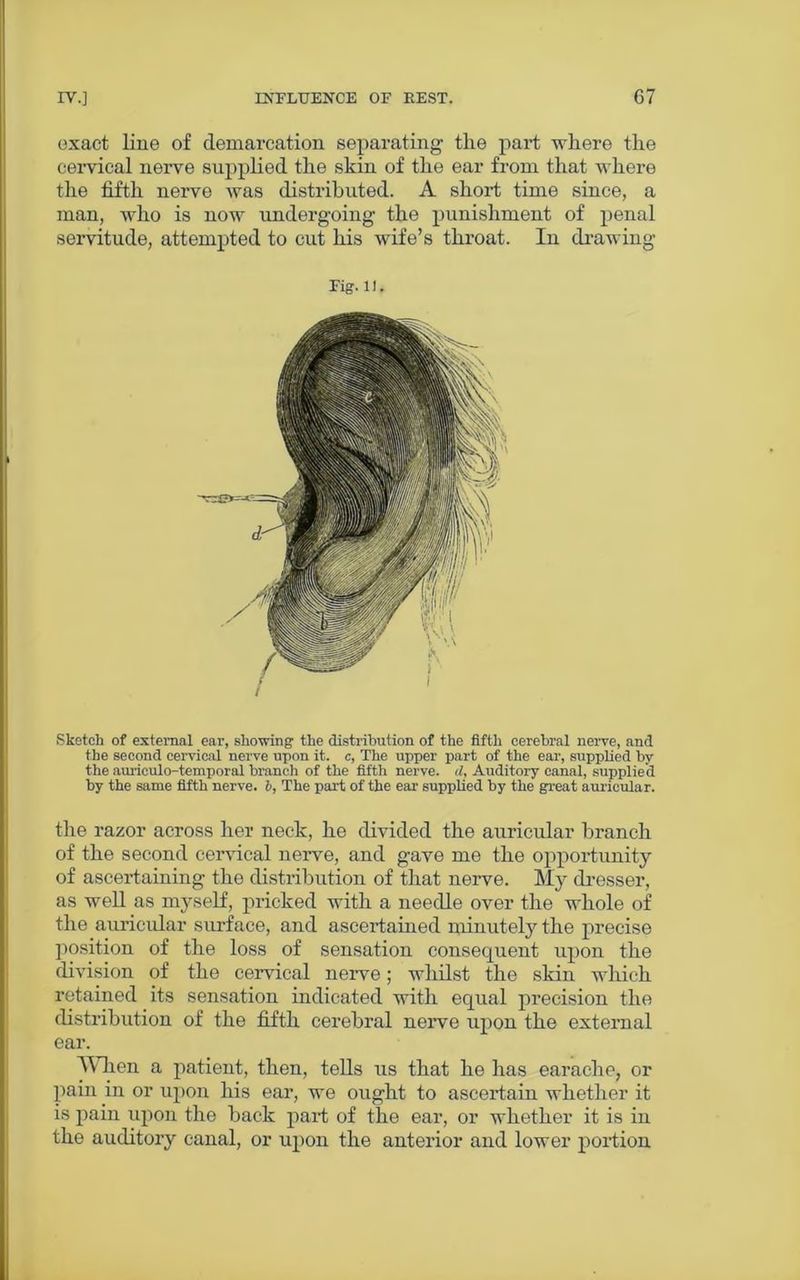exact line of demarcation separating the part where the cervical nerve supplied the skin of the ear from that where the fifth nerve was distributed. A short time since, a man, who is now undergoing the punishment of penal servitude, attempted to cut his wife’s throat. In drawing Fig. 11. Sketch of external ear, showing the distribution of the fifth cerebral nerve, and the second cervical nerve upon it. c, The upper part of the ear, supplied by the auriculo-temporal branch of the fifth nerve, d, Auditory canal, supplied by the same fifth nerve. 6, The part of the ear supplied by the great auricular. the razor across her neck, he divided the auricular branch of the second cervical nerve, and gave me the opportunity of ascertaining the distribution of that nerve. My dresser, as well as myself, pricked with a needle over the whole of the auricular surface, and ascertained minutely the precise position of the loss of sensation consequent upon the division of the cervical nerve; whilst the skin which retained its sensation indicated with equal precision the distribution of the fifth cerebral nerve upon the external ear. When a patient, then, tells us that he has earache, or pain in or upon his ear, we ought to ascertain whether it is pain upon the back part of the ear, or whether it is in the auditory canal, or upon the anterior and lower portion