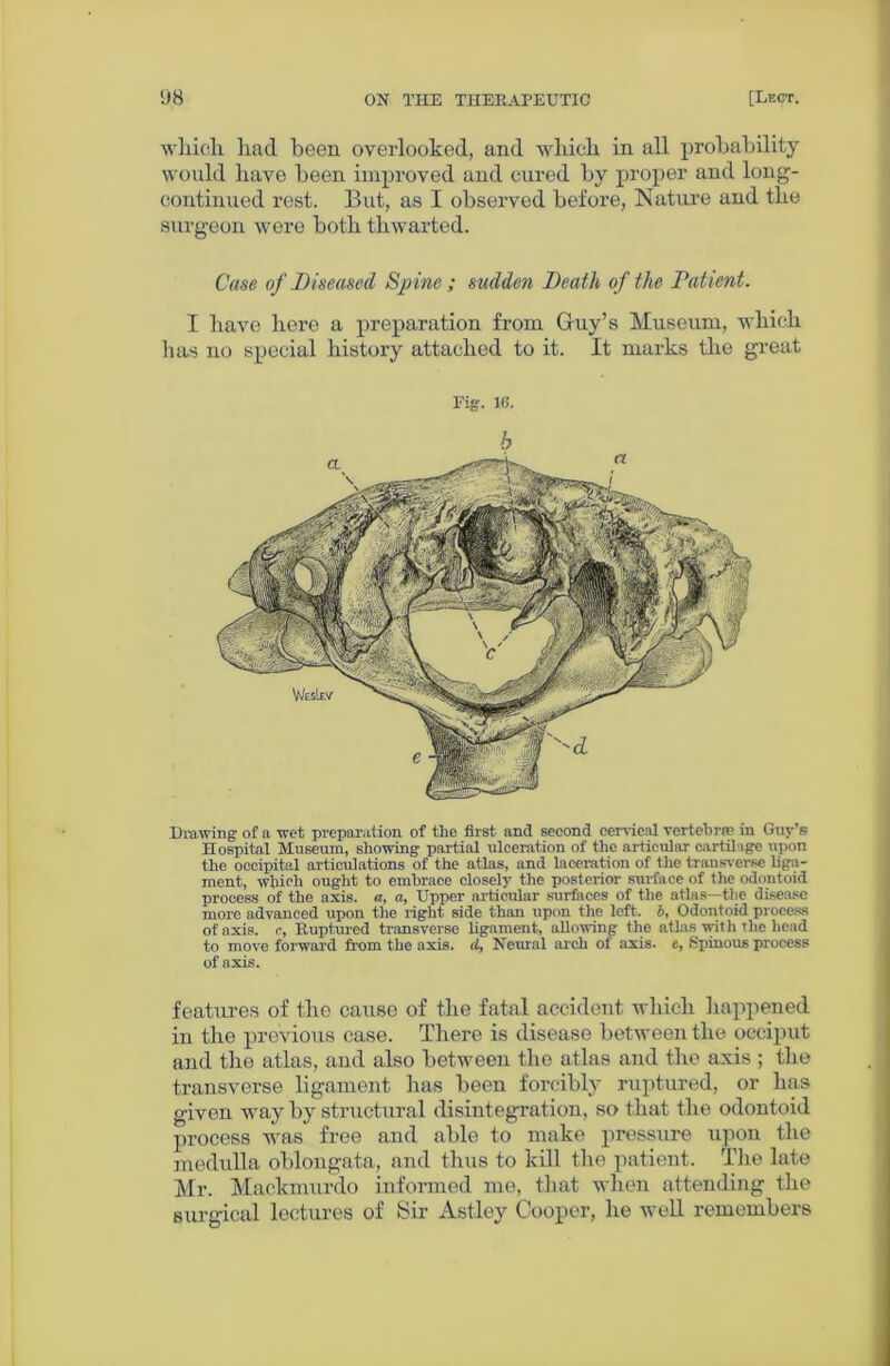 which had been overlooked, and which in all probability would have been improved and cured by proper and long- continued rest. But, as I observed before, Nature and the surgeon were both thwarted. Case of Diseased Spine ; sudden Death of the Patient. I have here a preparation from Guy’s Museum, which lias no special history attached to it. It marks the great Fig. ie. Drawing of a wet preparation of the first and second cervical vertebrae in Gnv’s Hospital Museum, showing partial ulceration of the articular cartilage upon the occipital articulations of the atlas, and laceration of the transverse liga- ment, which ought to embrace closely the posterior surface of the odontoid process of the axis. <t, a, Upper articular surfaces of the atlas—the disease more advanced upon the right side than upon the left, b, Odontoid process of axis, c, Ruptured transverse ligament, allowing the atlas with the head to move forward from the axis, tl. Neural arch of axis, e, Spinous process of axis. features of the cause of the fatal accident which happened in the previous case. There is disease between the occiput and the atlas, and also between the atlas and the axis ; the transverse ligament has been forcibly ruptured, or has given way by structural disintegration, so that the odontoid process was free and able to make pressure upon the medulla oblongata, and thus to kill the patient. The late Mr. Mackmurdo informed me, that when attending the surgical lectures of Sir Astley Cooper, he well remembers