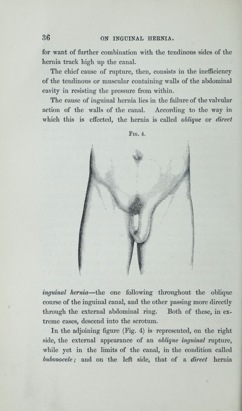 for want of further combination with the tendinous sides of the hernia track high up the canal. The chief cause of rupture, then, consists in the inefficiency of the tendinous or muscular containing walls of the abdominal cavity in resisting the pressure from within. The cause of inguinal hernia lies in the failure of the valvular action of the walls of the canal. According to the way in which this is effected, the hernia is called oblique or direct Fig. 4. inguinal hernia—the one following throughout the oblique course of the inguinal canal, and the other passing more directly through the external abdominal ring. Both of these, in ex- treme cases, descend into the scrotum. In the adjoining figure (Fig. 4) is represented, on the right side, the external appearance of an oblique inguinal rupture, while yet in the limits of the canal, in the condition called bubonocele; and on the left side, that of a direct hernia