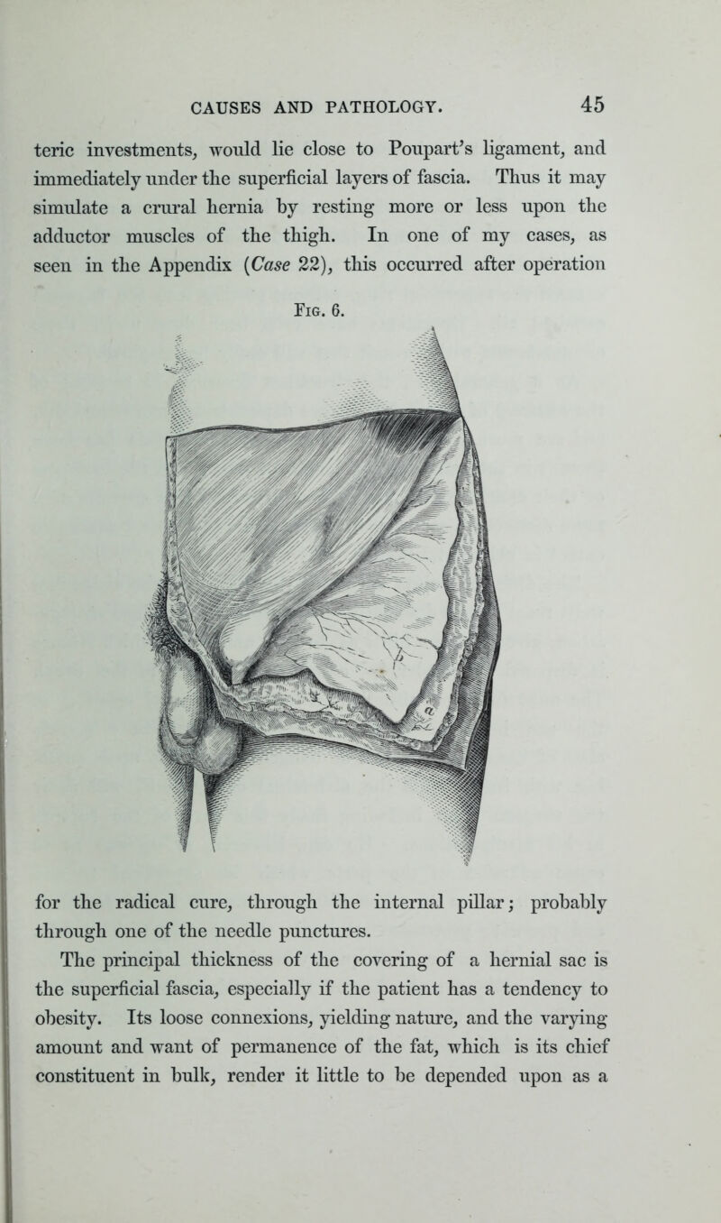 teric investments, would lie close to Poupart's ligament, and immediately nnder the superficial layers of fascia. Thus it may simulate a crural hernia by resting more or less upon the adductor muscles of the thigh. In one of my cases, as seen in the Appendix {Case 22), this occurred after operation Fig. 6. for the radical cure, through the internal pillar; probably through one of the needle punctures. The principal thickness of the covering of a hernial sac is the superficial fascia, especially if the patient has a tendency to obesity. Its loose connexions, yielding nature, and the varying amount and want of permanence of the fat, which is its chief constituent in bulk, render it little to be depended upon as a