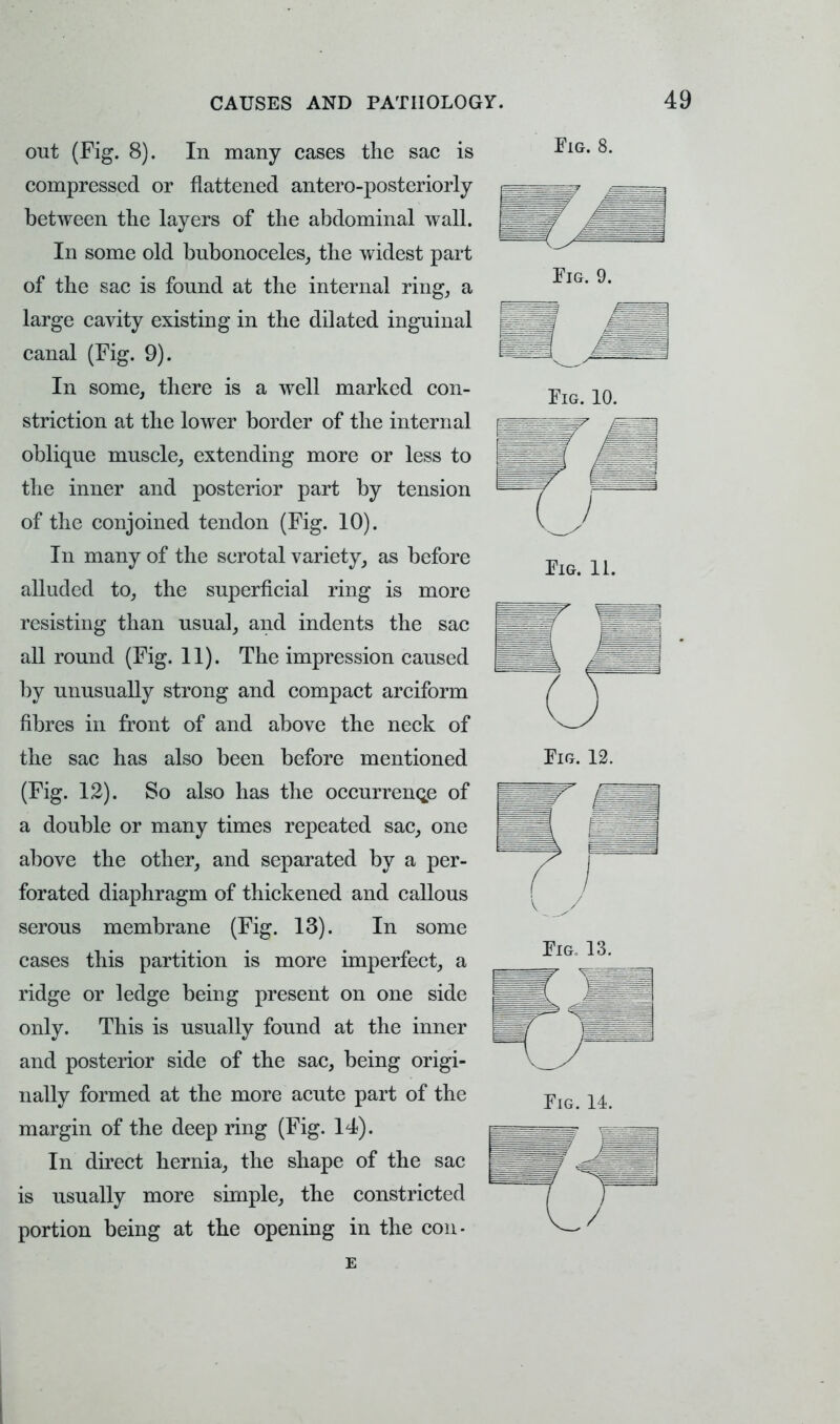 out (Fig. 8). In many cases the sac is compressed or flattened antero-posteriorly between the layers of the abdominal wall. In some old bubonoceles, the widest part of the sac is found at the internal ring, a large cavity existing in the dilated inguinal fe canal (Fig. 9). ■ In some, there is a well marked con- striction at the lower border of the internal p oblique muscle, extending more or less to the inner and posterior part by tension of the conjoined tendon (Fig. 10). In many of the scrotal variety, as before alluded to, the superficial ring is more resisting than usual, and indents the sac all round (Fig. 11). The impression caused by unusually strong and compact arciform fibres in front of and above the neck of the sac has also been before mentioned (Fig. 12). So also has the occurrence of a double or many times repeated sac, one above the other, and separated by a per- forated diaphragm of thickened and callous serous membrane (Fig. 13). In some cases this partition is more imperfect, a ridge or ledge being present on one side only. This is usually found at the inner and posterior side of the sac, being origi- nally formed at the more acute part of the margin of the deep ring (Fig. 14). In direct hernia, the shape of the sac is usually more simple, the constricted portion being at the opening in the con-