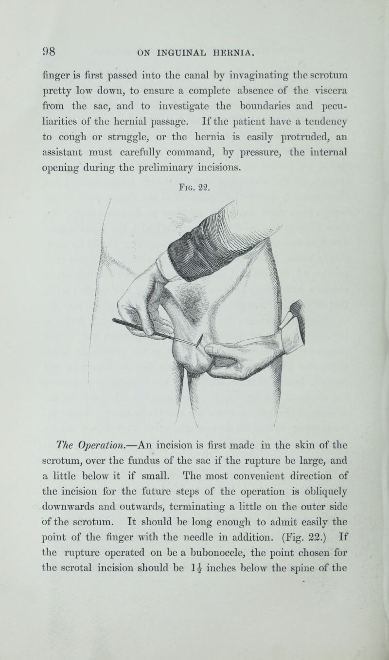 finger is first passed into the canal by invaginating the scrotum pretty low down, to ensure a complete absence of the viscera from the sac, and to investigate the boundaries and pecu- liarities of the hernial passage. If the patient have a tendency to cough or struggle, or the hernia is easily protruded, an assistant must carefully command, by pressure, the internal opening during the preliminary incisions. Fig. 22. The Operation.—An incision is first made in the skin of the scrotum, over the fundus of the sac if the rupture be large, and a little below it if small. The most convenient direction of the incision for the future steps of the operation is obliquely downwards and outwards, terminating a little on the outer side of the scrotum. It should be long enough to admit easily the point of the finger with the needle in addition. (Fig. 22.) If the rupture operated on be a bubonocele, the point chosen for the scrotal incision should be lh inches below the spine of the