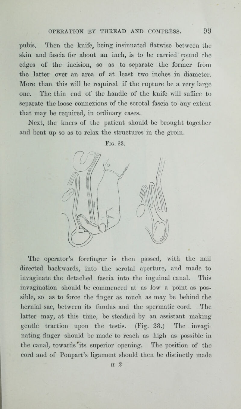 pubis. Then the knife, being insinuated flatwise between the skin and fascia for about an inch, is to be carried round the edges of the incision, so as to separate the former from the latter over an area of at least two inches in diameter. More than this will be required if the rupture be a very large one. The thin end of the handle of the knife will suffice to separate the loose connexions of the scrotal fascia to any extent that may be required, in ordinary cases. Next, the knees of the patient should be brought together and bent up so as to relax the structures in the groin. Fig. 23. The operator's forefinger is then passed, with the nail directed backwards, into the scrotal aperture, and made to invaginate the detached fascia into the inguinal canal. This invagination should be commenced at as low a point as pos- sible, so as to force the finger as much as may be behind the hernial sac, between its fundus and the spermatic cord. The latter may, at this time, be steadied by an assistant making gentle traction upon the testis. (Fig. 23.) The invagi- nating finger should be made to reach as high as possible in the canal, towards 'its superior opening. The position of the cord and of Poupart's ligament should then be distinctly made h 2