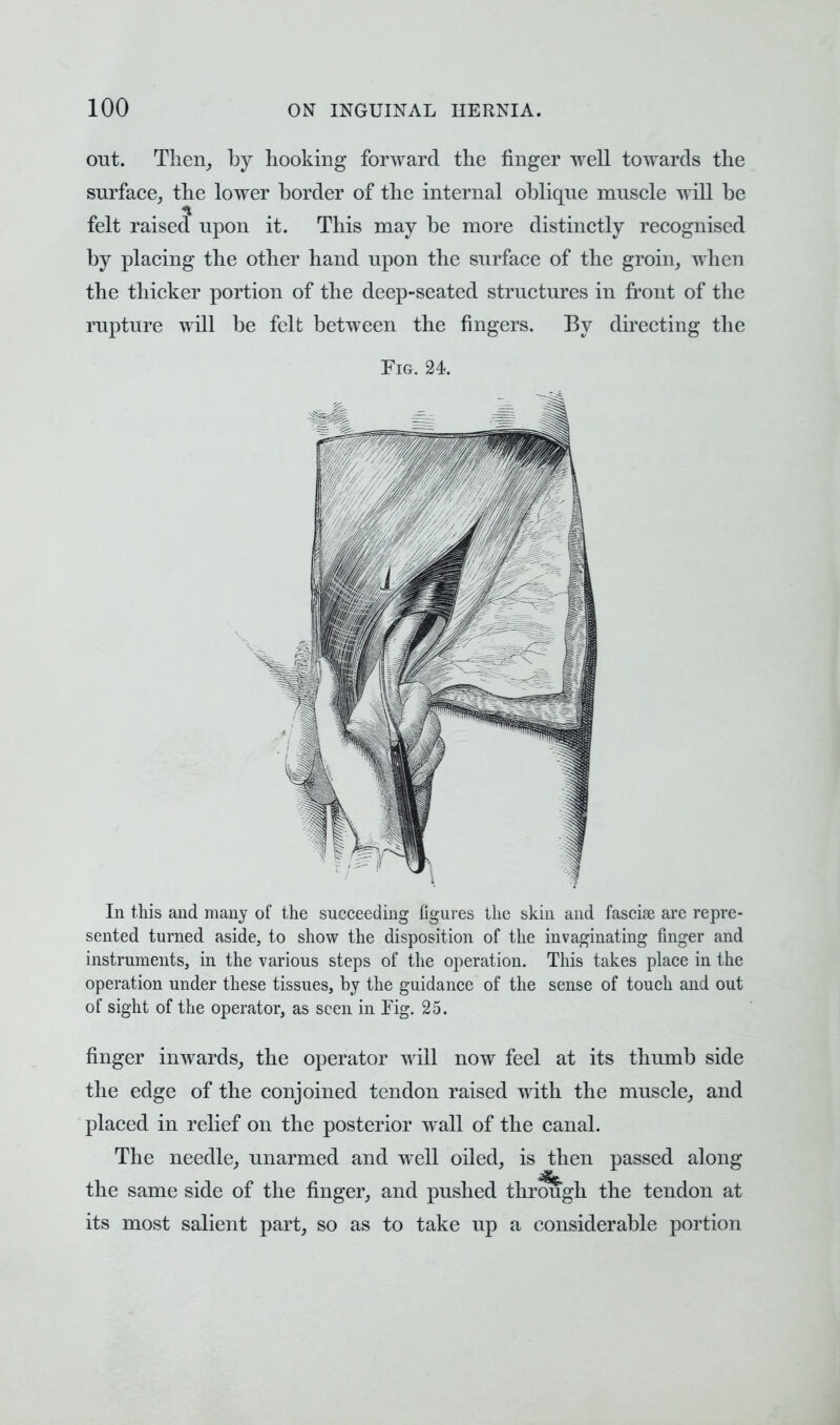 out. Their, by hooking forward the finger well towards the surface, the lower border of the internal oblique muscle will be felt raised upon it. This may be more distinctly recognised by placing the other hand upon the surface of the groin, when the thicker portion of the deep-seated structures in front of the rupture will be felt between the fingers. By directing the Fig. 24. In this and many of the succeeding figures the skin and fascise are repre- sented turned aside, to show the disposition of the invaginating finger and instruments, in the various steps of the operation. This takes place in the operation under these tissues, by the guidance of the sense of touch and out of sight of the operator, as seen in Tig. 25. finger inwards, the operator will now feel at its thumb side the edge of the conjoined tendon raised with the muscle, and placed in relief on the posterior wall of the canal. The needle, unarmed and well oiled, is then passed along the same side of the finger, and pushed through the tendon at its most salient part, so as to take up a considerable portion