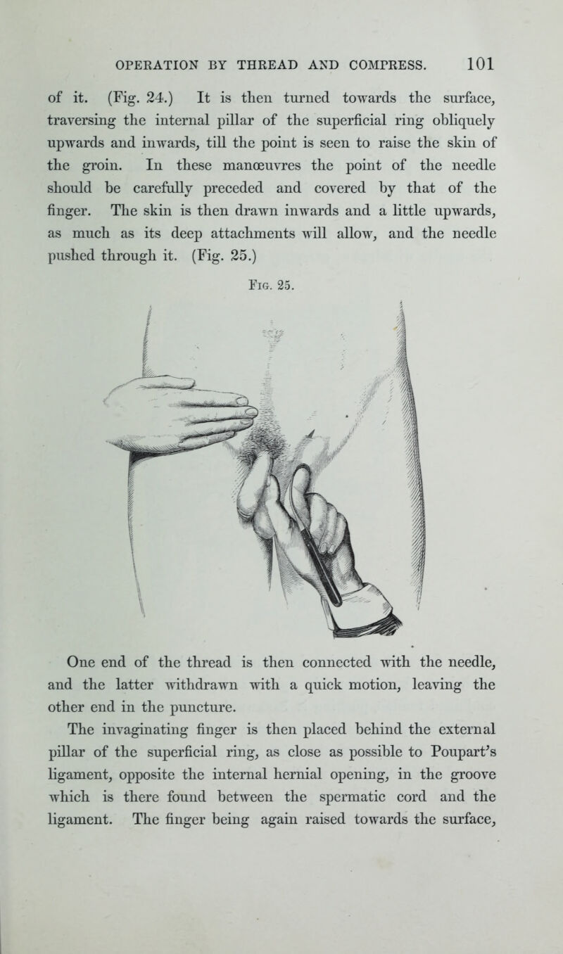 of it. (Fig. 24.) It is then turned towards the surface, traversing the internal pillar of the superficial ring obliquely upwards and inwards, till the point is seen to raise the skin of the groin. In these manoeuvres the point of the needle should be carefully preceded and covered by that of the finger. The skin is then drawn inwards and a little upwards, as much as its deep attachments will allow, and the needle pushed through it. (Fig. 25.) Fig. 25. One end of the thread is then connected with the needle, and the latter withdrawn with a quick motion, leaving the other end in the puncture. The invaginating finger is then placed behind the external pillar of the superficial ring, as close as possible to Poupart's ligament, opposite the internal hernial opening, in the groove which is there found between the spermatic cord and the ligament. The finger being again raised towards the surface,