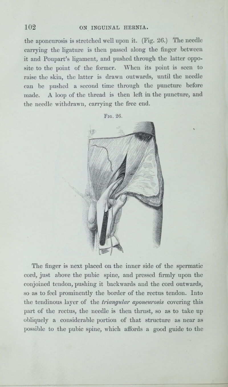 the aponeurosis is stretched well upon it. (Fig. 26.) The needle carrying the ligature is then passed along the finger between it and Poupartfs ligament, and pushed through the latter oppo- site to the point of the former. When its point is seen to raise the skin, the latter is drawn outwards, until the needle can he pushed a second time through the puncture before made. A loop of the thread is then left in the puncture, and the needle withdrawn, carrying the free end. Fig. 26. The finger is next placed on the inner side of the spermatic cord, just above the pubic spine, and pressed firmly upon the conjoined tendon, pushing it backwards and the cord outwards, so as to feel prominently the border of the rectus tendon. Into the tendinous layer of the triangular aponeurosis covering this part of the rectus, the needle is then thrust, so as to take up obliquely a considerable portion of that structure as near as possible to the pubic spine, which affords a good guide to the