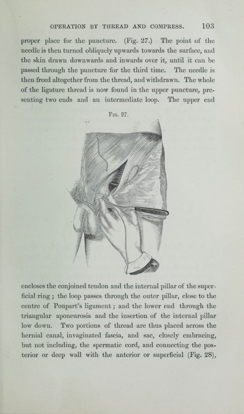 proper place for the puncture. (Fig. 27.) The point of the needle is then turned obliquely upwards towards the surface, and the skin drawn downwards and inwards over it, until it can be passed through the puncture for the third time. The needle is then freed altogether from the thread, and withdrawn. The whole of the ligature thread is now found in the upper puncture, pre- senting two ends and an intermediate loop. The upper end Fig. 27. encloses the conjoined tendon and the internal pillar of the super - ficial ring ; the loop passes through the outer pillar, close to the centre of Poupart's ligament; and the lower end through the triangular aponeurosis and the insertion of the internal pillar low down. Two portions of thread are thus placed across the hernial canal, invaginated fascia, and sac, closely embracing, but not including, the spermatic cord, and connecting the pos- terior or deep wall with the anterior or superficial (Fig. 28),