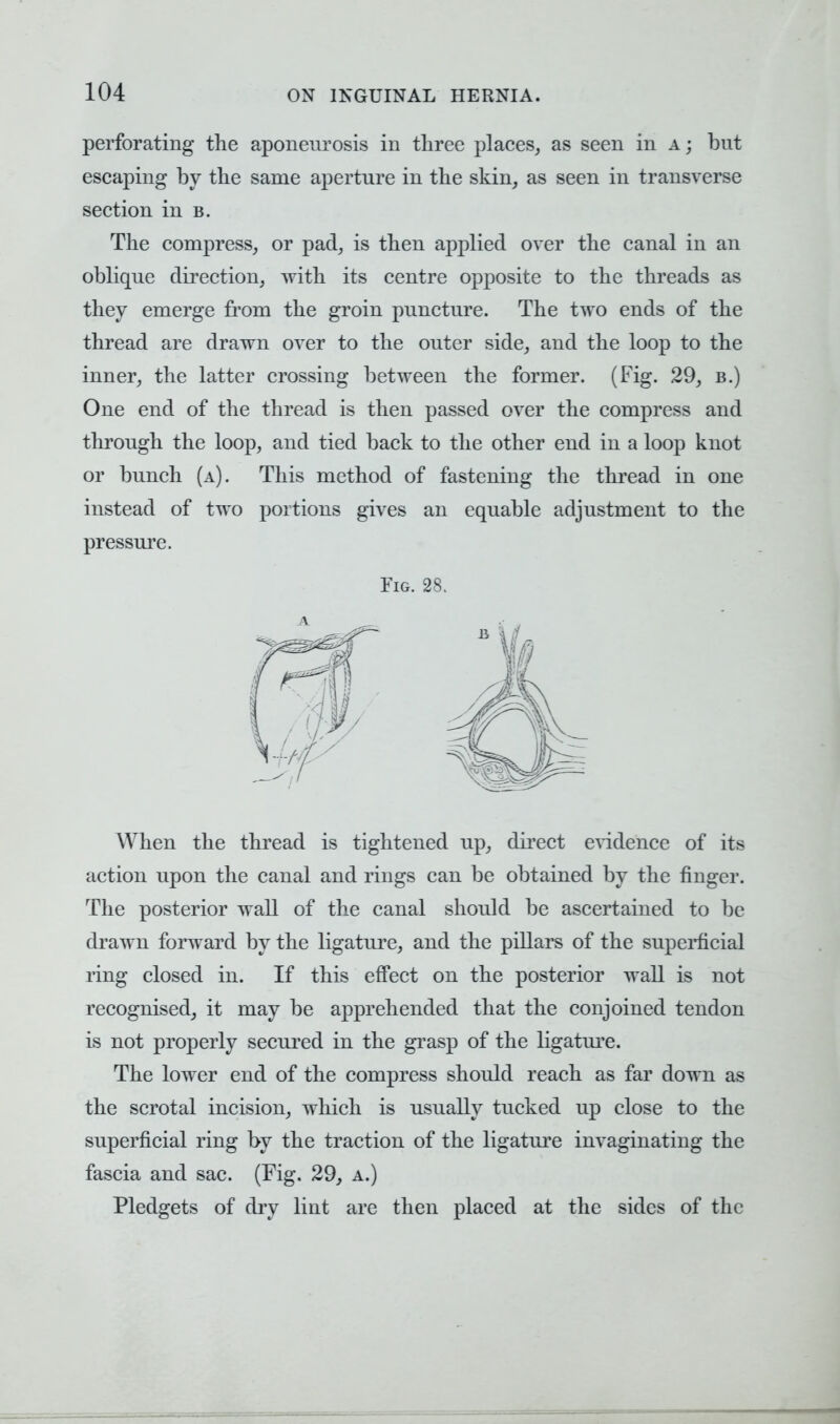 perforating the aponeurosis in three places, as seen in a; but escaping by the same aperture in the skin, as seen in transverse section in b. The compress, or pad, is then applied over the canal in an oblique direction, with its centre opposite to the threads as they emerge from the groin puncture. The two ends of the thread are drawn over to the outer side, and the loop to the inner, the latter crossing between the former. (Fig. 29, b.) One end of the thread is then passed over the compress and through the loop, and tied back to the other end in a loop knot or bunch (a). This method of fastening the thread in one instead of two portions gives an equable adjustment to the pressure. Fig. 28. When the thread is tightened up, direct evidence of its action upon the canal and rings can be obtained by the finger. The posterior wall of the canal should be ascertained to be drawn forward by the ligature, and the pillars of the superficial ring closed in. If this effect on the posterior wall is not recognised, it may be apprehended that the conjoined tendon is not properly secured in the grasp of the ligature. The lower end of the compress should reach as far down as the scrotal incision, which is usually tucked up close to the superficial ring by the traction of the ligature invaginating the fascia and sac. (Fig. 29, a.) Pledgets of dry lint are then placed at the sides of the