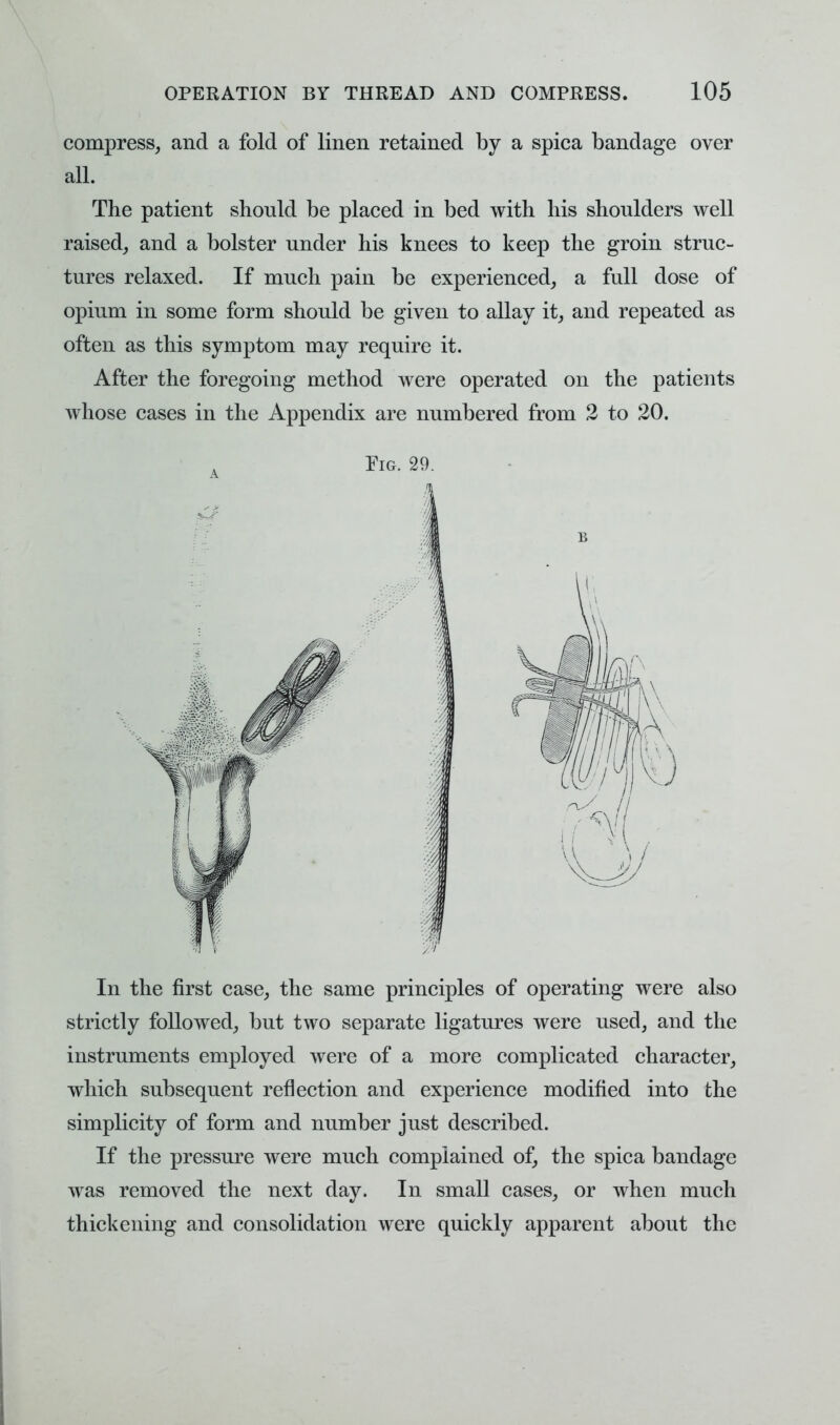 compress, and a fold of linen retained by a spica bandage over all. The patient should be placed in bed with his shoulders well raised, and a bolster under his knees to keep the groin struc- tures relaxed. If much pain be experienced, a full dose of opium in some form should be given to allay it, and repeated as often as this symptom may require it. After the foregoing method were operated on the patients whose cases in the Appendix are numbered from 2 to 20. Pig. 29. In the first case, the same principles of operating were also strictly followed, but two separate ligatures were used, and the instruments employed were of a more complicated character, which subsequent reflection and experience modified into the simplicity of form and number just described. If the pressure were much complained of, the spica bandage was removed the next day. In small cases, or when much thickening and consolidation were quickly apparent about the