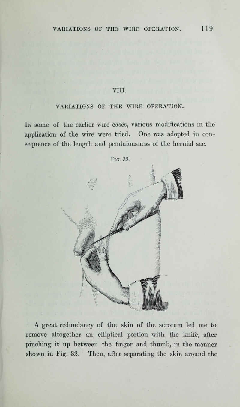VIII. VARIATIONS OF THE WIRE OPERATION. In some of the earlier wire cases, various modifications in the application of the wire were tried. One was adopted in con- sequence of the length and pendulousness of the hernial sac. Fig. 32. A great redundancy of the skin of the scrotum led me to remove altogether an elliptical portion with the knife, after pinching it up between the finger and thumb, in the manner shown in Fig. 32. Then, after separating the skin around the