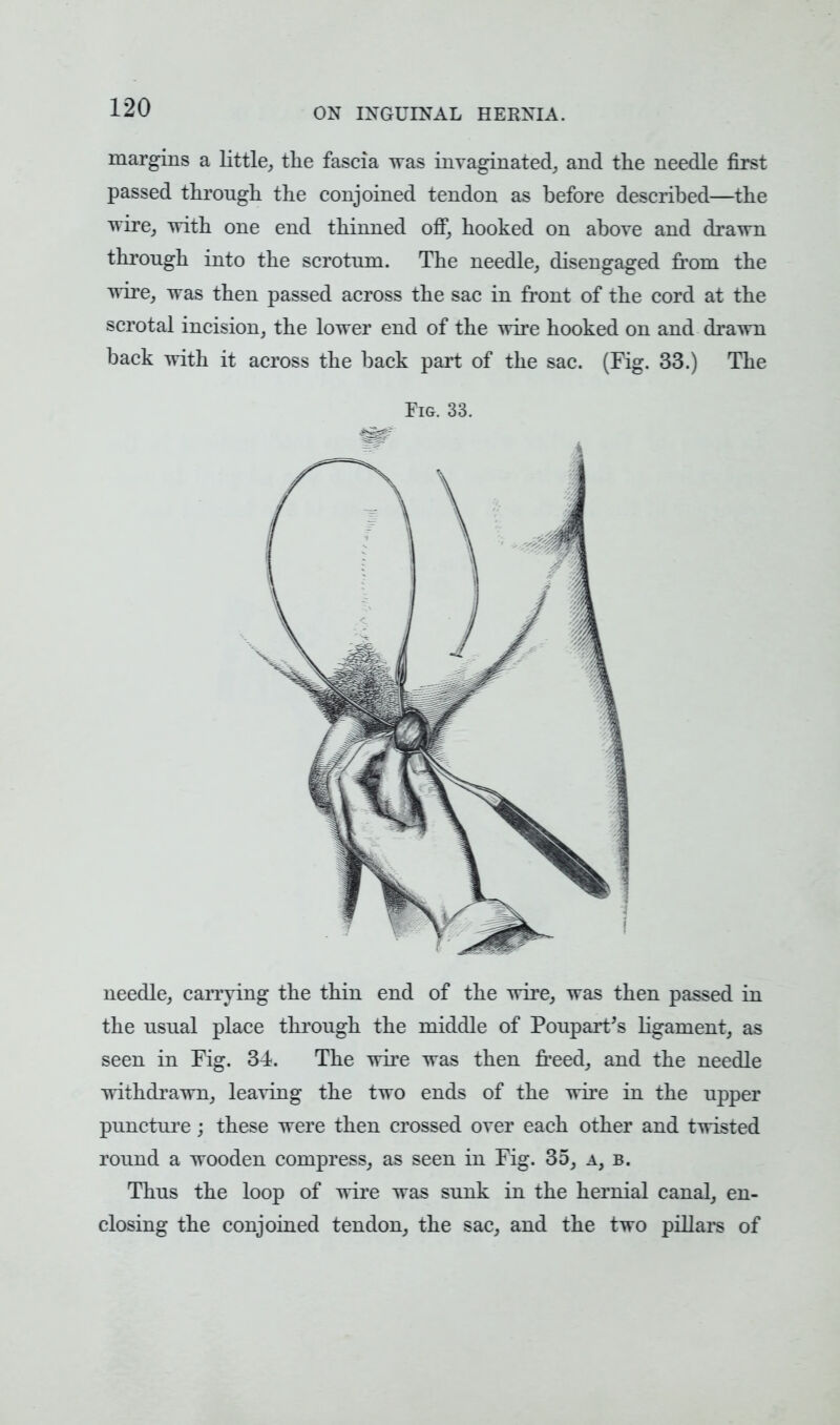 margins a little, the fascia was invaginated, and the needle first passed through the conjoined tendon as before described—the wire, with one end thinned off, hooked on above and drawn through into the scrotum. The needle, disengaged from the wire, was then passed across the sac in front of the cord at the scrotal incision, the lower end of the wire hooked on and drawn back with it across the back part of the sac. (Fig. 33.) The Fig. 33. needle, carrying the thin end of the wire, was then passed in the usual place through the middle of Poupart's ligament, as seen in Fig. 34. The wire was then freed, and the needle withdrawn, leaving the two ends of the wire in the upper puncture; these were then crossed over each other and twisted round a wooden compress, as seen in Fig. 35, a, b. Thus the loop of wire was sunk in the hernial canal, en- closing the conjoined tendon, the sac, and the two pillars of