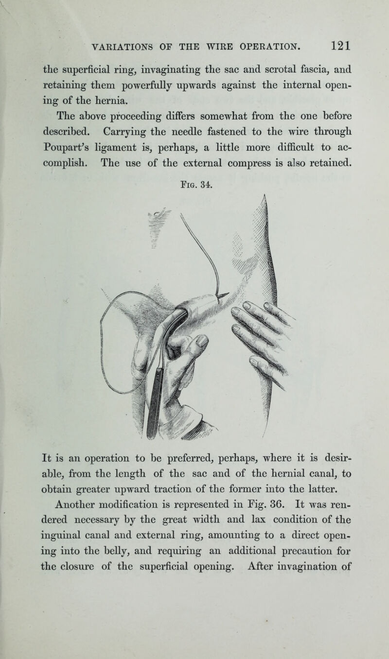 the superficial ring, invaginating the sac and scrotal fascia, and retaining them powerfully upwards against the internal open- ing of the hernia. The above proceeding differs somewhat from the one before described. Carrying the needle fastened to the wire through Poupart's ligament is, perhaps, a little more difficult to ac- complish. The use of the external compress is also retained. Fig. 34. It is an operation to be preferred, perhaps, where it is desir- able, from the length of the sac and of the hernial canal, to obtain greater upward traction of the former into the latter. Another modification is represented in Fig. 36. It was ren- dered necessary by the great width and lax condition of the inguinal canal and external ring, amounting to a direct open- ing into the belly, and requiring an additional precaution for the closure of the superficial opening. After invagination of