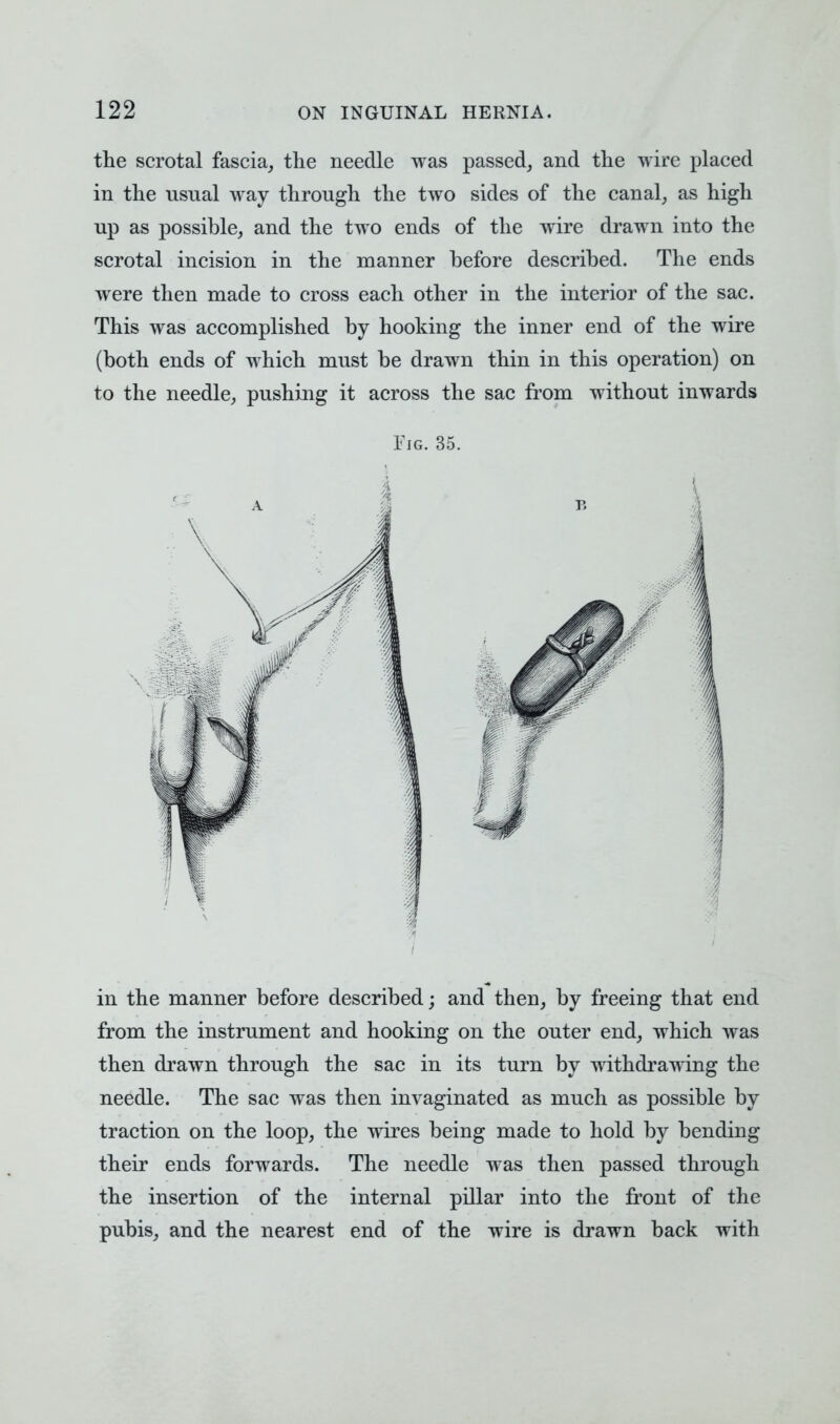 the scrotal fascia, the needle was passed, and the wire placed in the usual way through the two sides of the canal, as high up as possible, and the two ends of the wire drawn into the scrotal incision in the manner before described. The ends were then made to cross each other in the interior of the sac. This was accomplished by hooking the inner end of the wire (both ends of which must be drawn thin in this operation) on to the needle, pushing it across the sac from without inwards Fig. 35. in the manner before described; and then, by freeing that end from the instrument and hooking on the outer end, which was then drawn through the sac in its turn by withdrawing the needle. The sac was then invaginated as much as possible by traction on the loop, the wires being made to hold by bending their ends forwards. The needle was then passed through the insertion of the internal pillar into the front of the pubis, and the nearest end of the wire is drawn back with