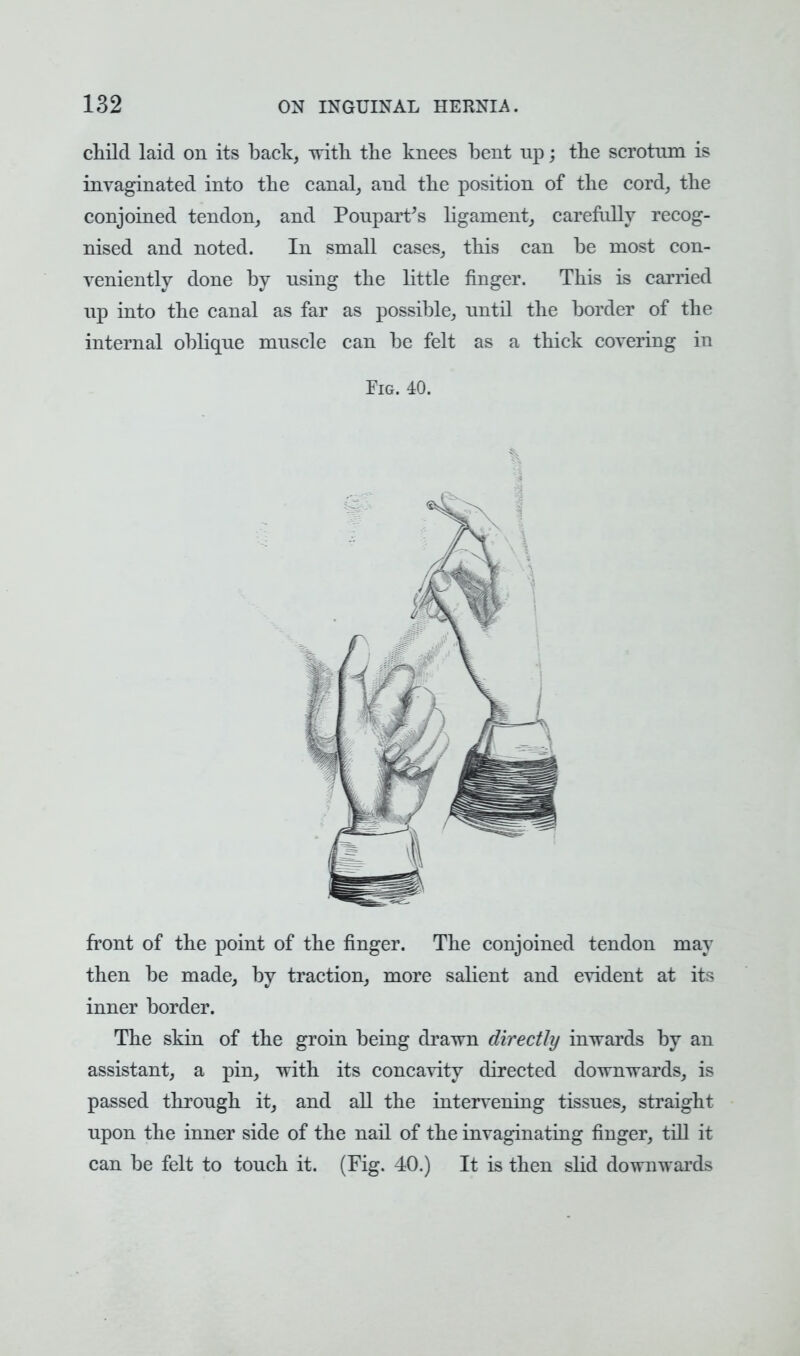 child laid on its back, with the knees bent np; the scrotum is invaginated into the canal, and the position of the cord, the conjoined tendon, and Poupart's ligament, carefully recog- nised and noted. In small cases, this can be most con- veniently done by using the little finger. This is carried up into the canal as far as possible, until the border of the internal oblique muscle can be felt as a thick covering in Fig. 40. 1 front of the point of the finger. The conjoined tendon may then be made, by traction, more salient and evident at its inner border. The skin of the groin being drawn directly inwards by an assistant, a pin, with its concavity directed downwards, is passed through it, and all the intervening tissues, straight upon the inner side of the nail of the invaginating finger, till it can be felt to touch it. (Fig. 40.) It is then slid downwards